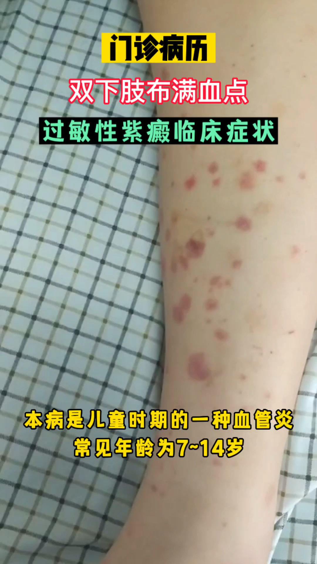 本病多发生于学龄期儿童，常见发病年龄为7～14岁