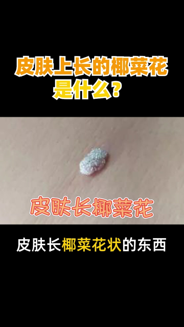 皮肤上长的椰菜花,是什么?