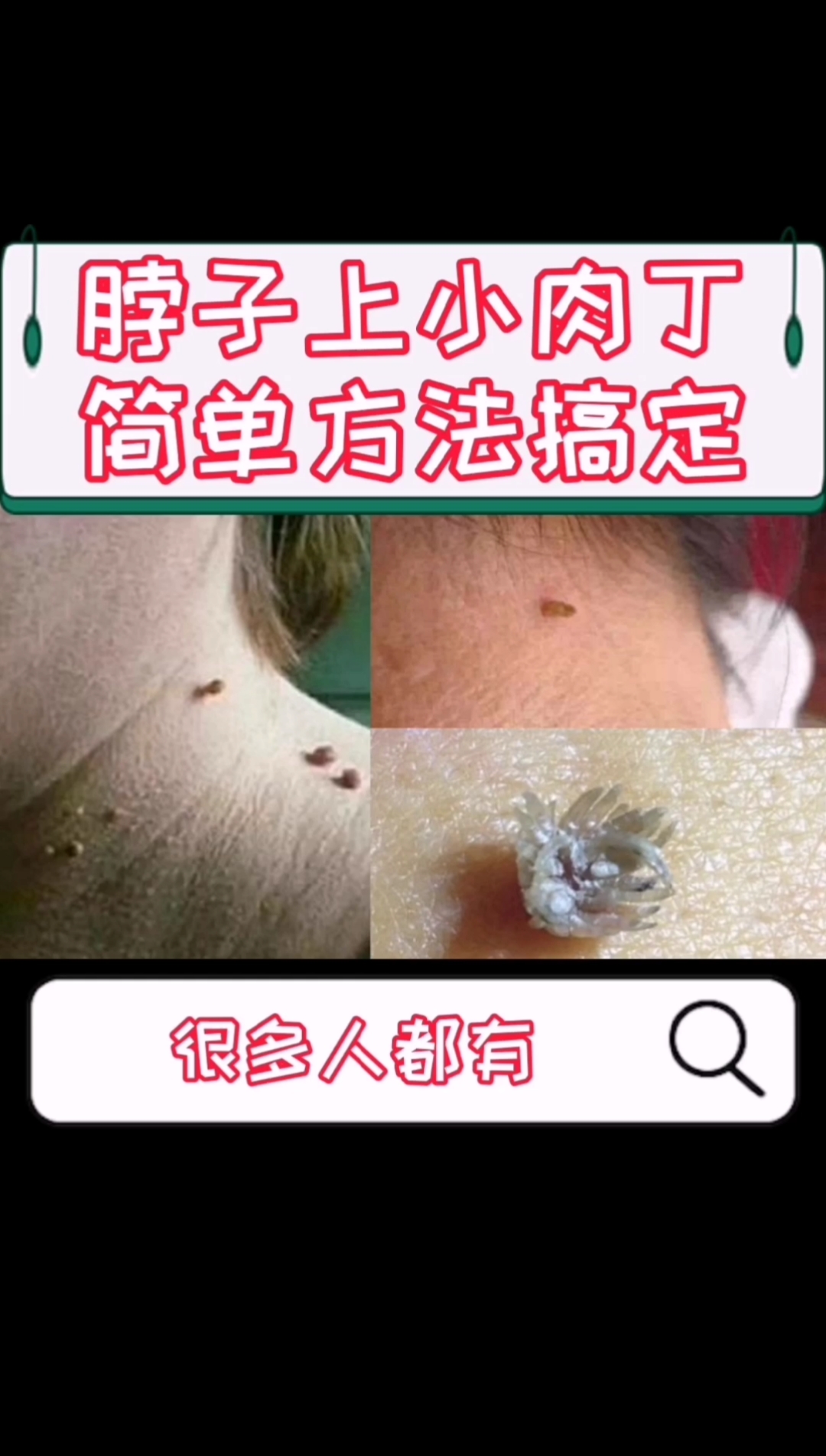 #健康养生#脖子上面小肉丁,简单方法可以处理