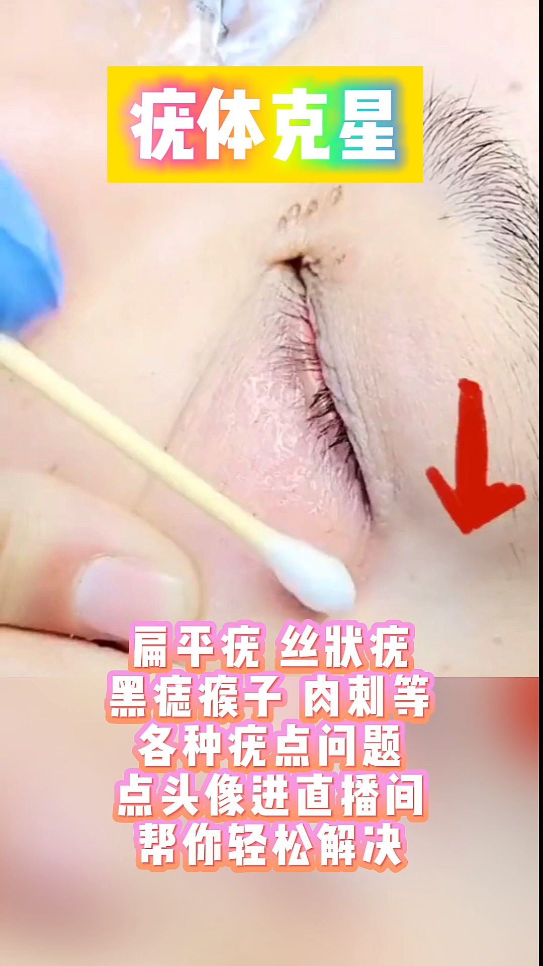 疣体克星。扁平疣丝状疣黑痣瘊子肉刺等各种疣点问题点头像进道播间帮你轻松解决
