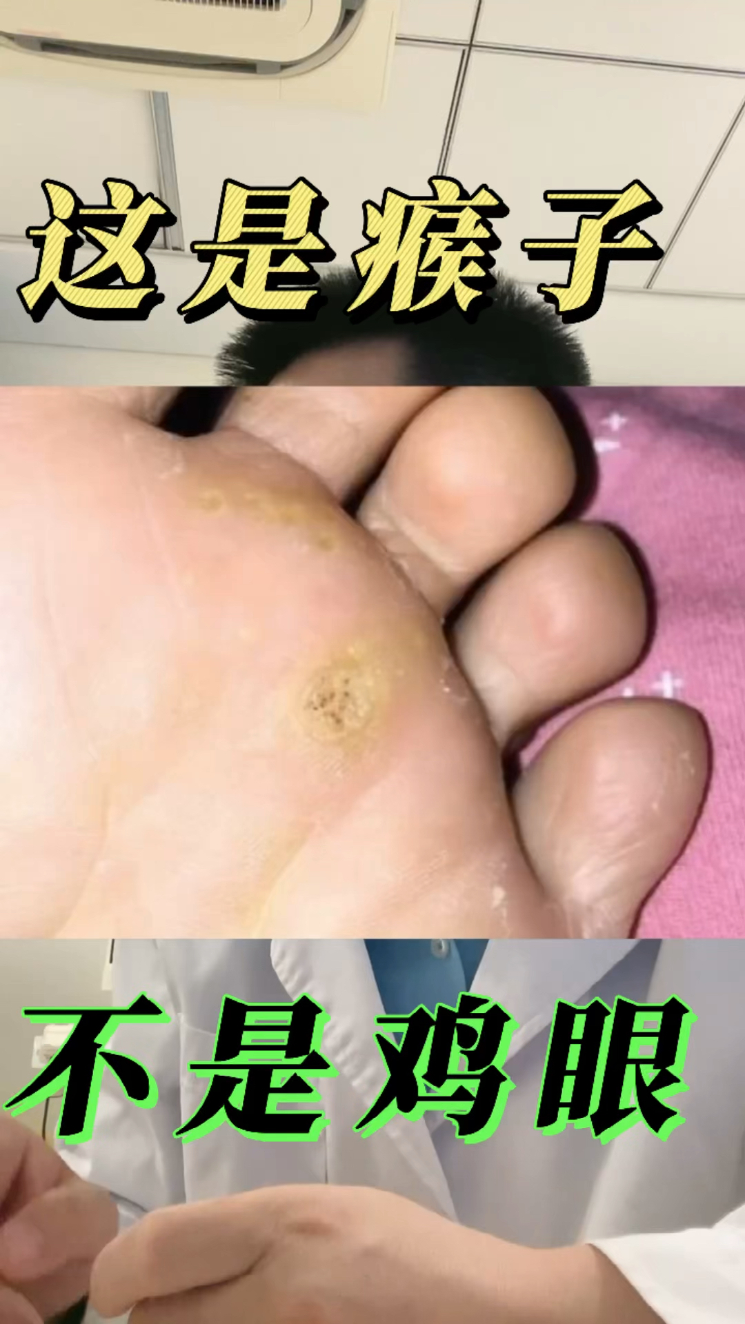 #全民医生说#千万不要把脚上的瘊子当成鸡眼，因为它有传染性，可能会越长越多