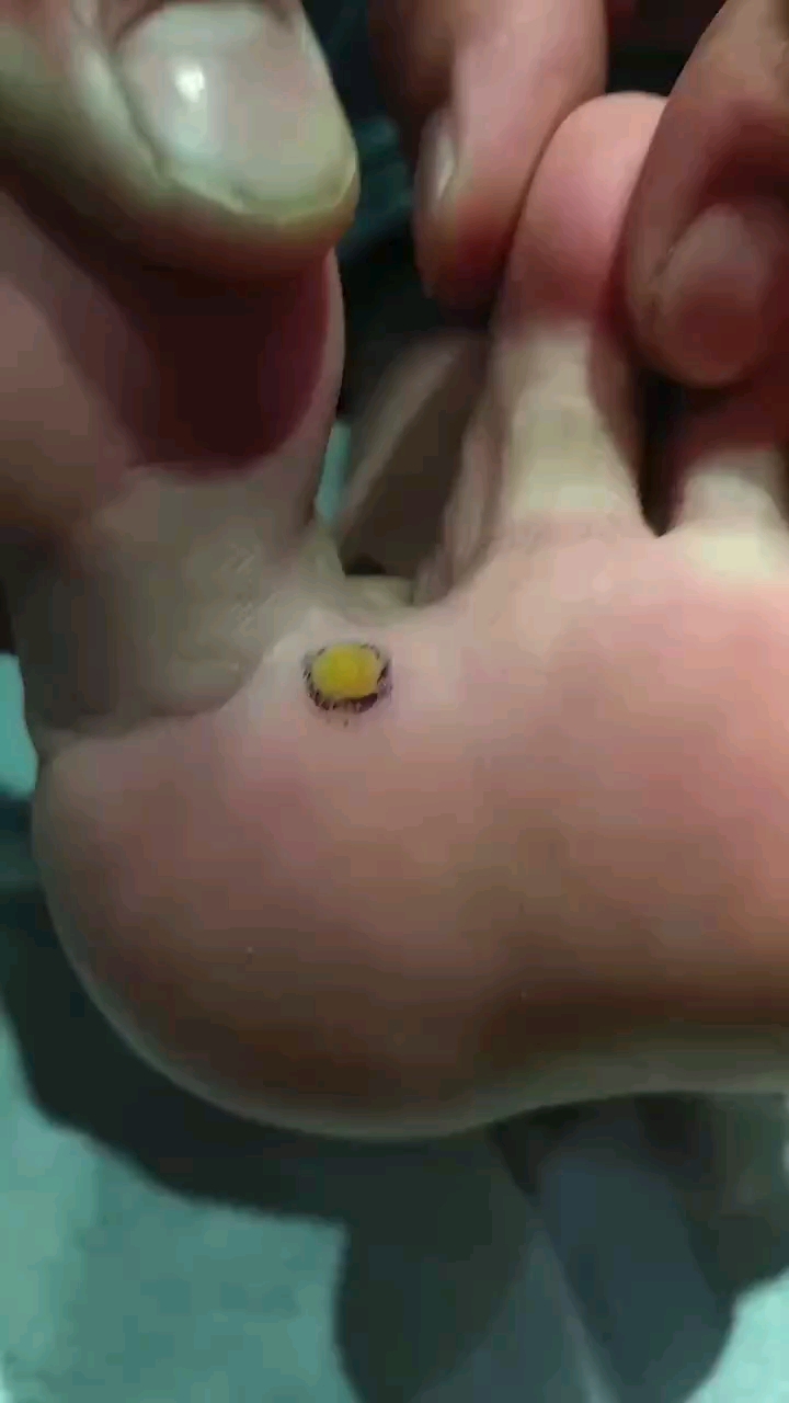 鸡眼老茧脱落过程