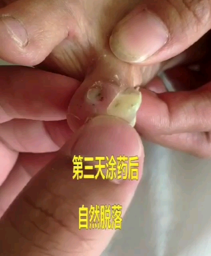脚趾鸡眼涂抹产品脱落过程