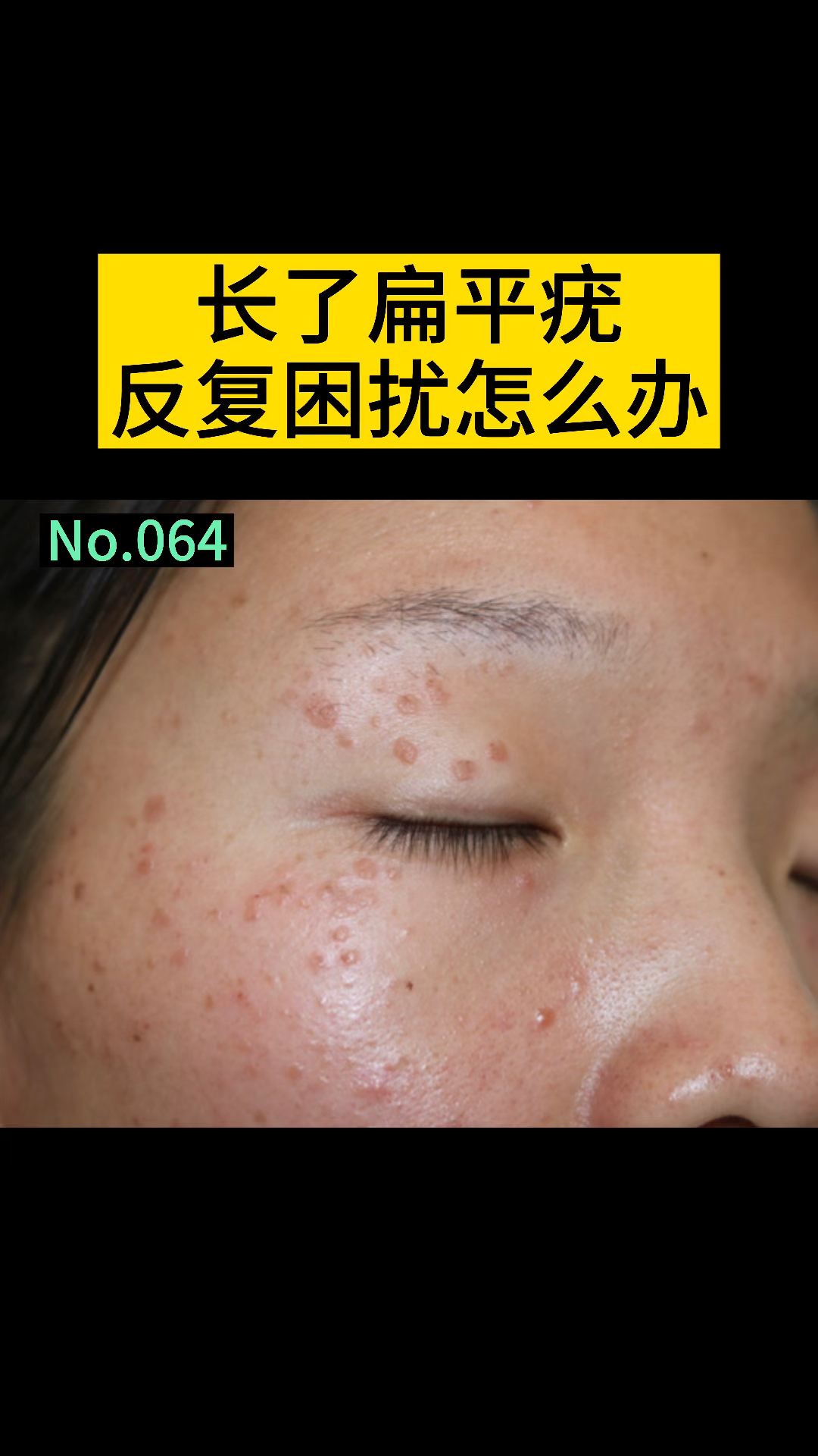 #健康科普#脸上长扁平疣,这个方法帮你解决!