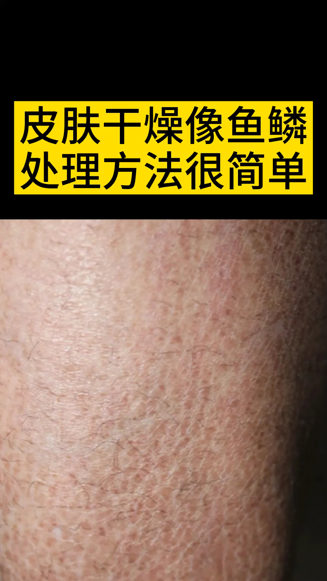 #传递健康正能量#小腿上皮肤干燥像鱼鳞，这样就可以搞定！