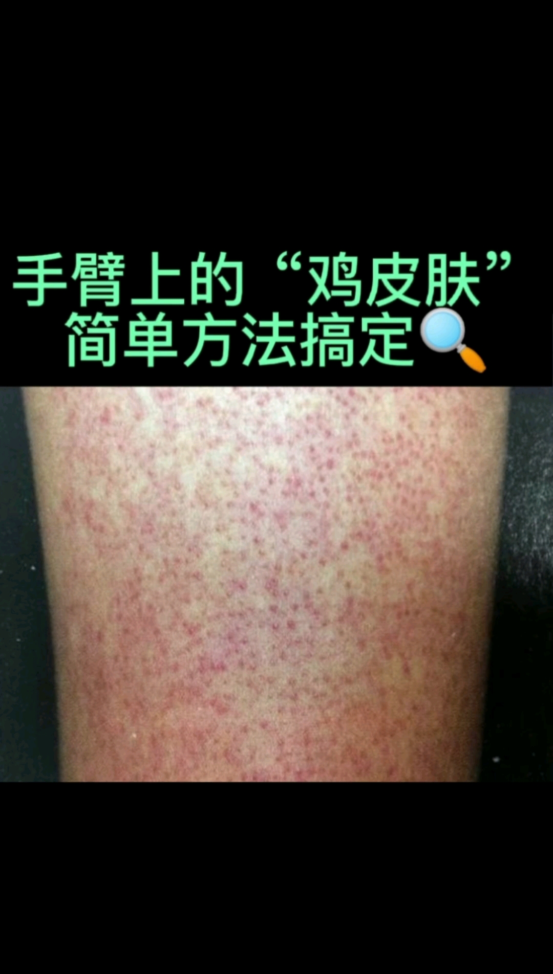 #不一样的人生#手臂的鸡皮肤,不要挤压会感染!