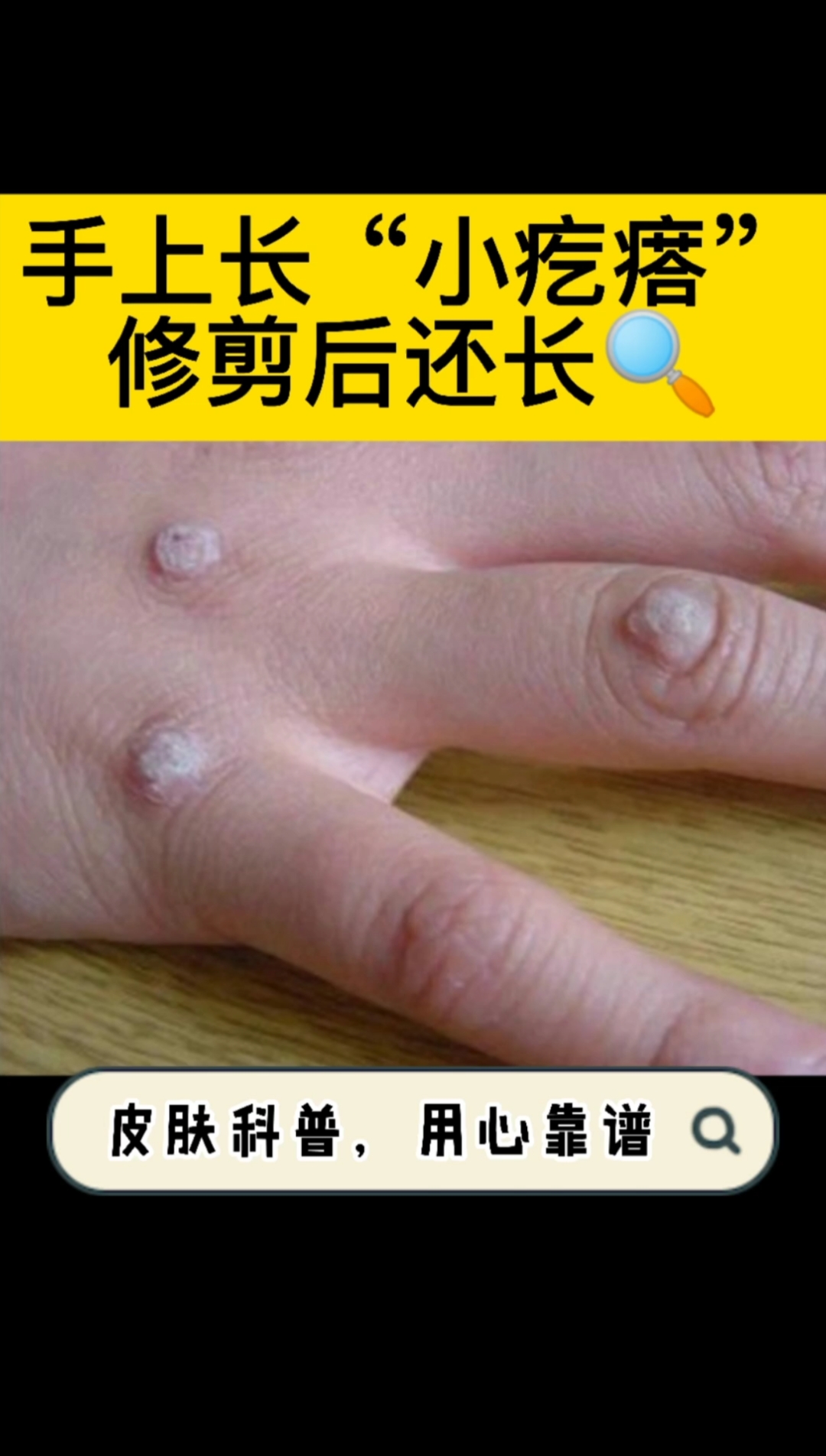 手上这种小疙瘩,你中招过吗?