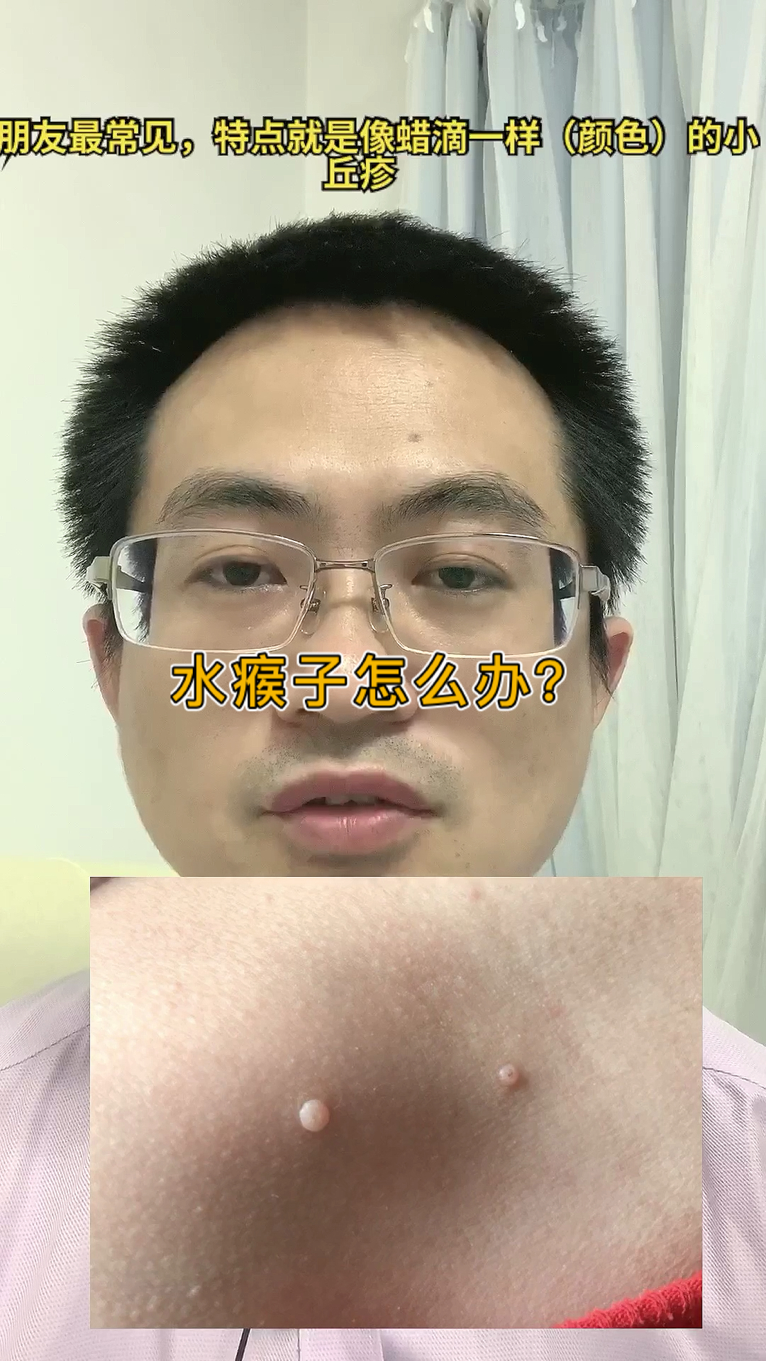 #全民医生说#水瘊子怎么治疗呢?