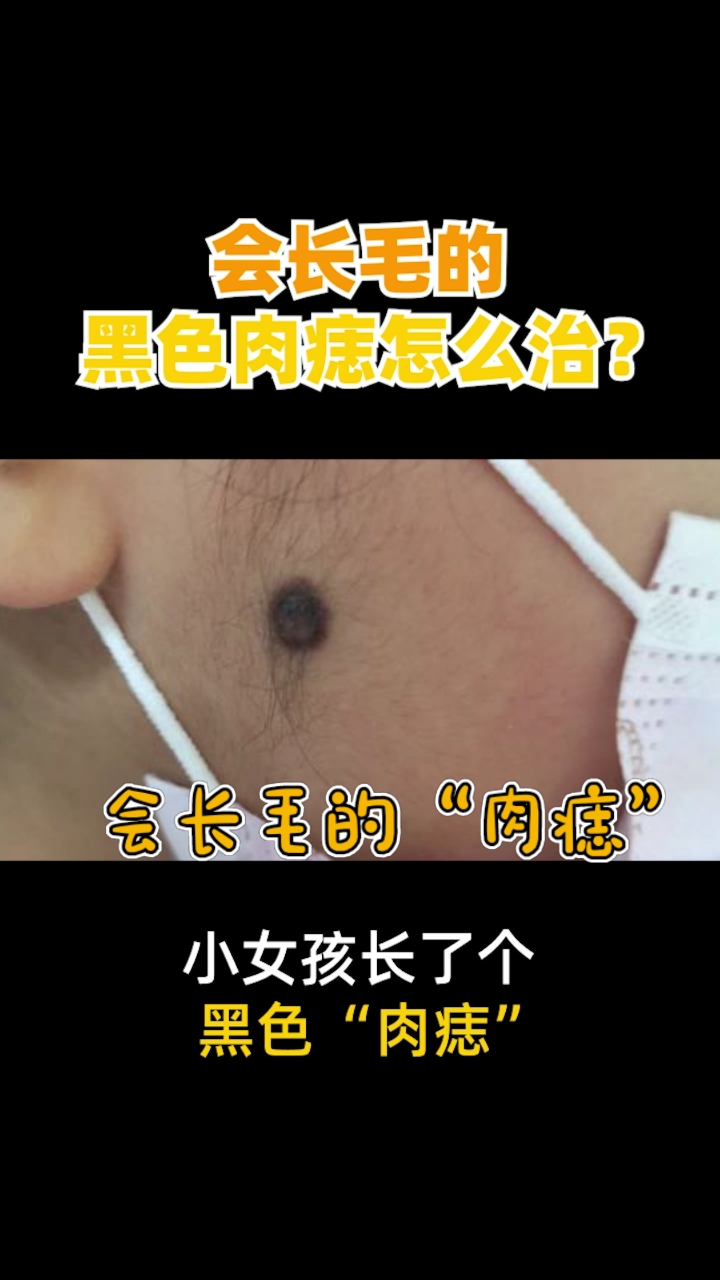 会长毛的黑色肉痣,怎么治?