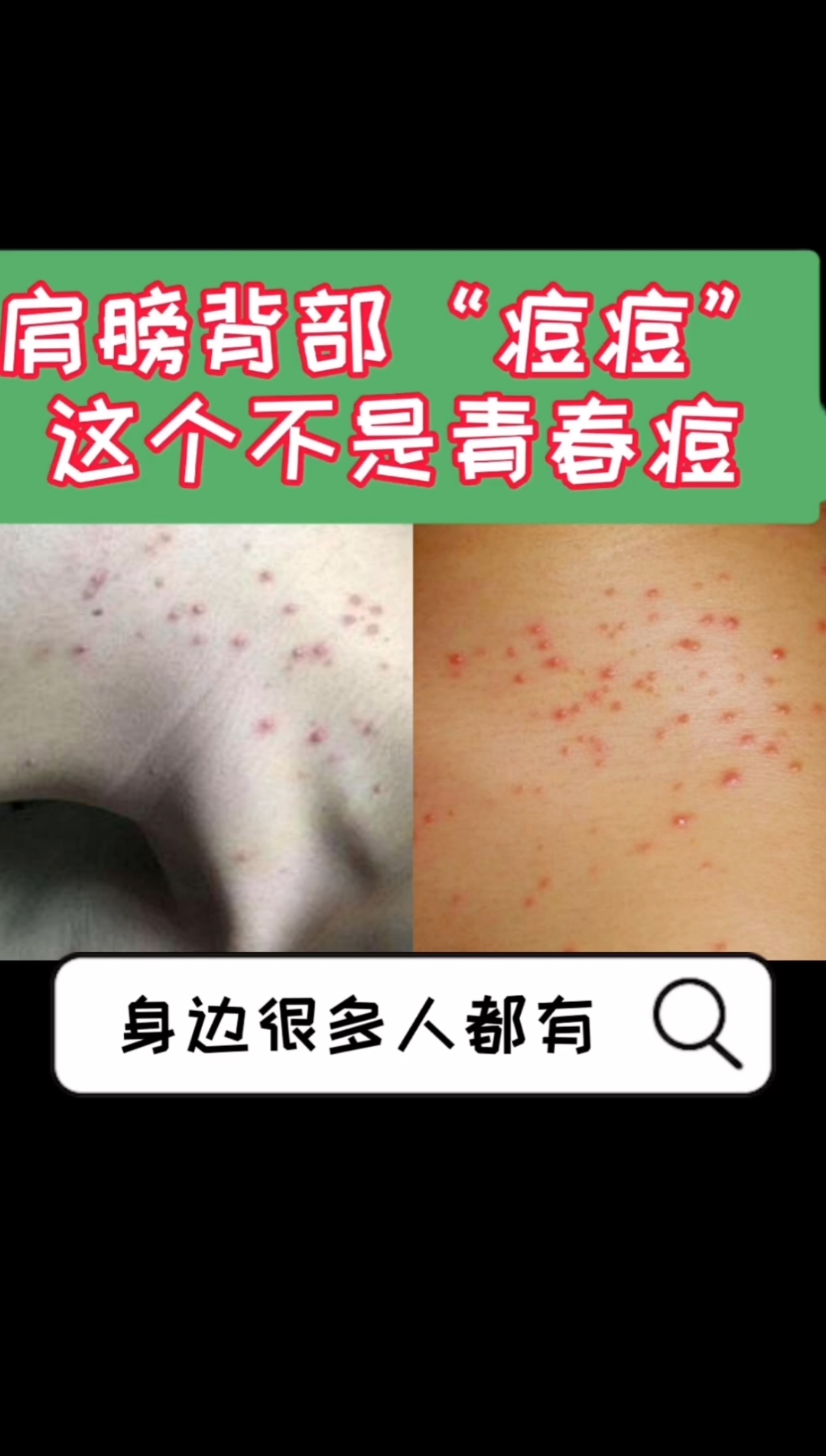 #每天一点冷知识#很多人肩膀、胸背部长痘痘,这个不是“青春痘”,记住了啊!