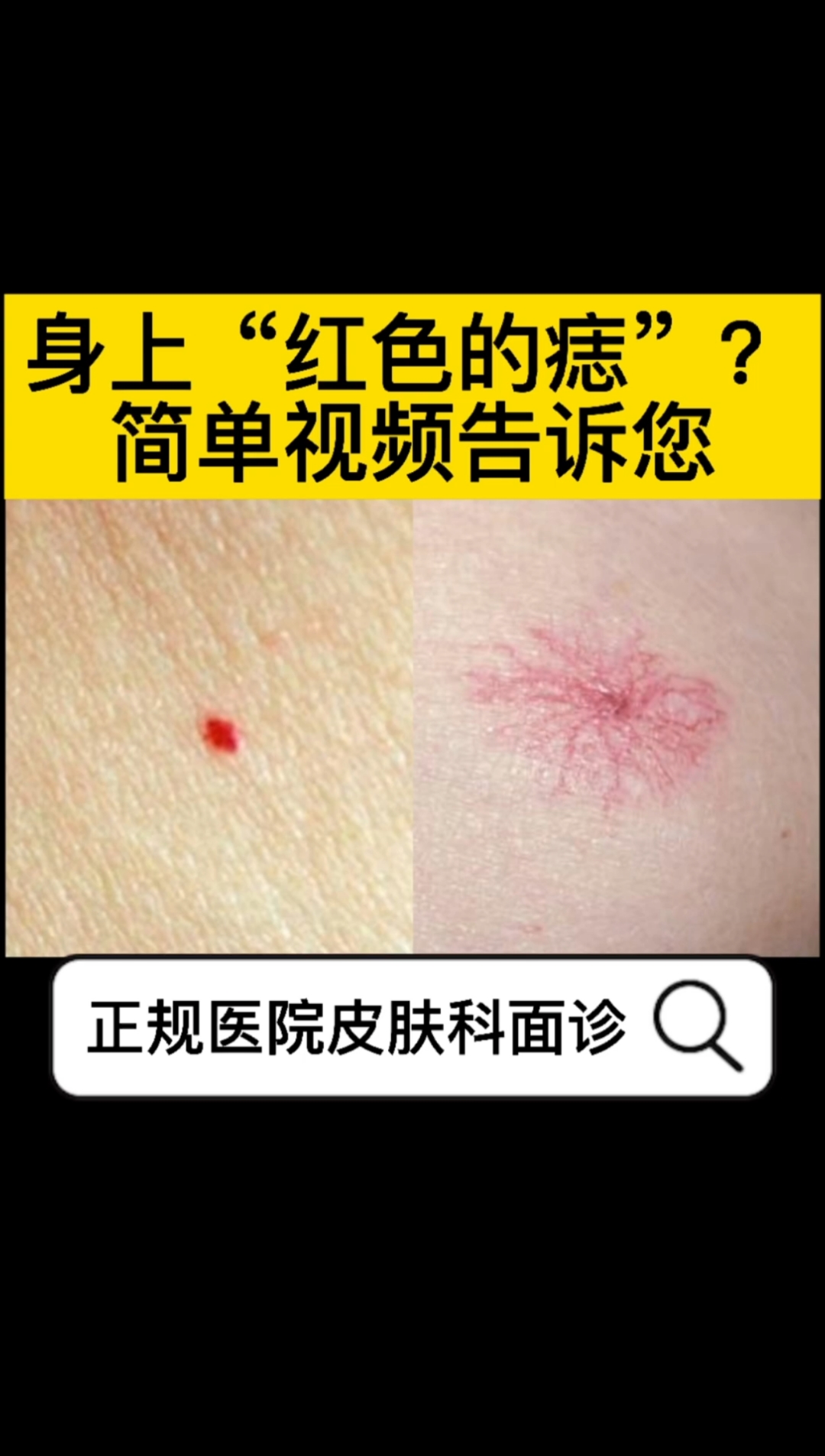 #不一样的人生#身上“红色的痣”，你知道是什么吗？