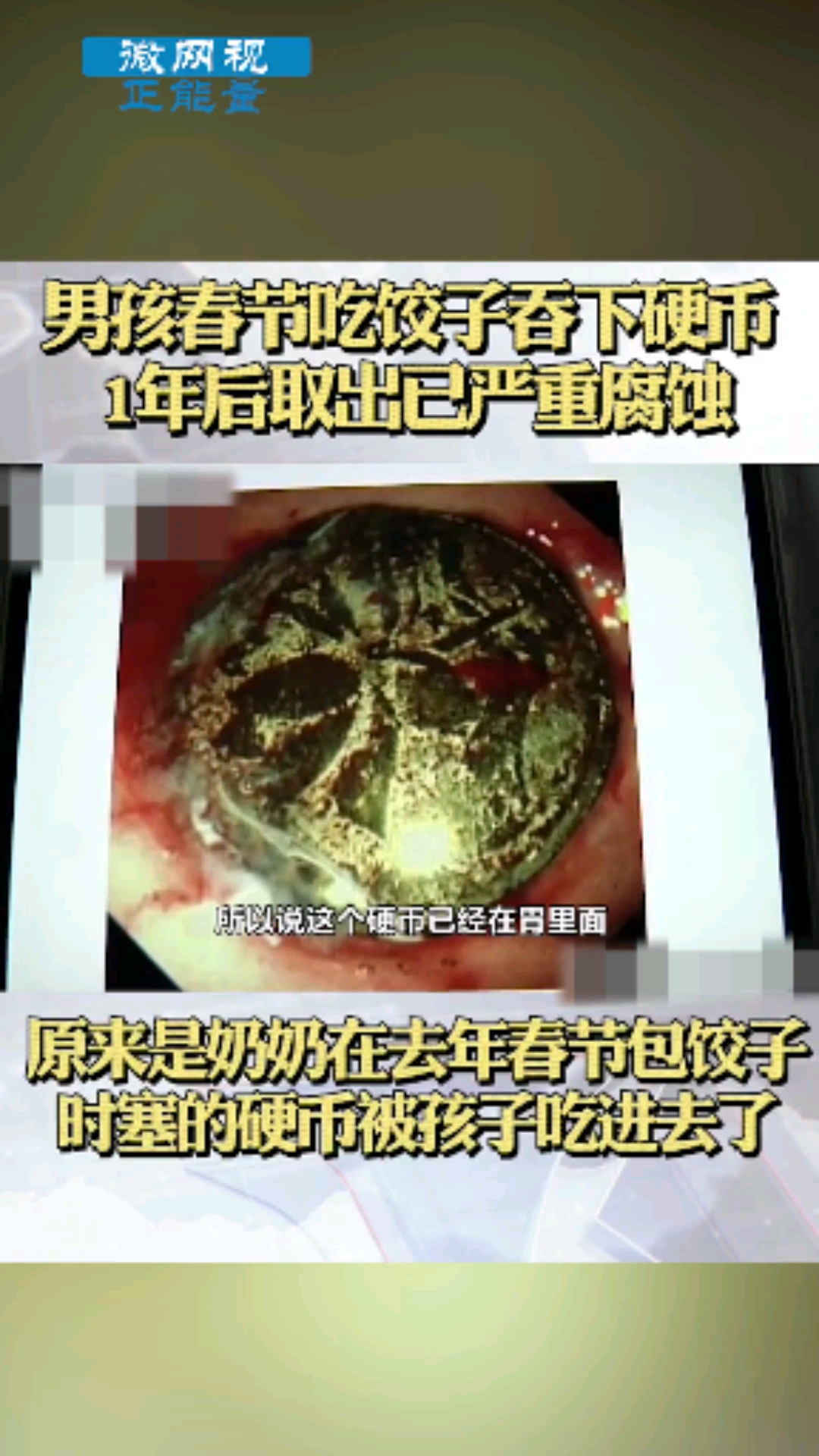 #全民正能量##安全#男孩春节吃饺子吞下硬币海盗1年后取出已经严重腐蚀。