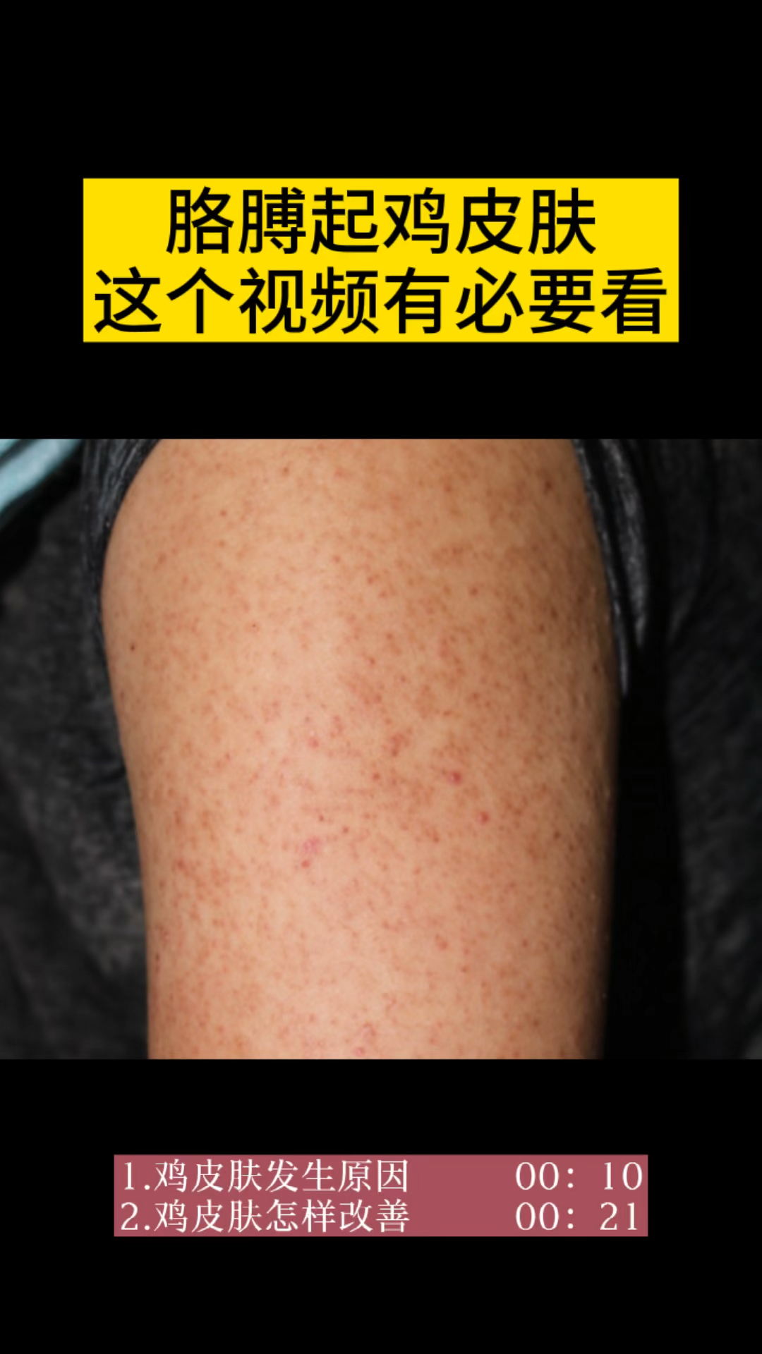 #医学科普#困扰很久的鸡皮肤,终于解决了