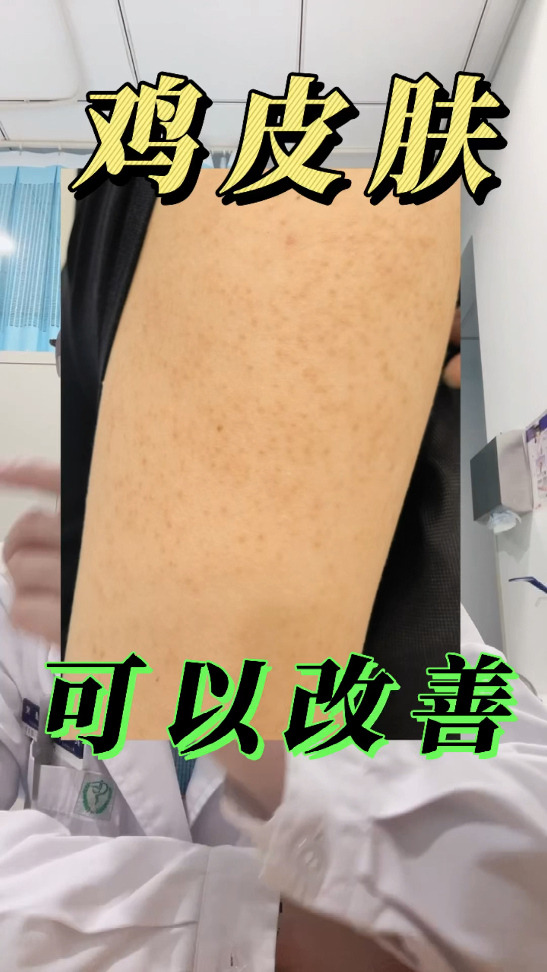 #全民医生说#两个胳膊持续多年的鸡皮肤,有没有什么方法改善?