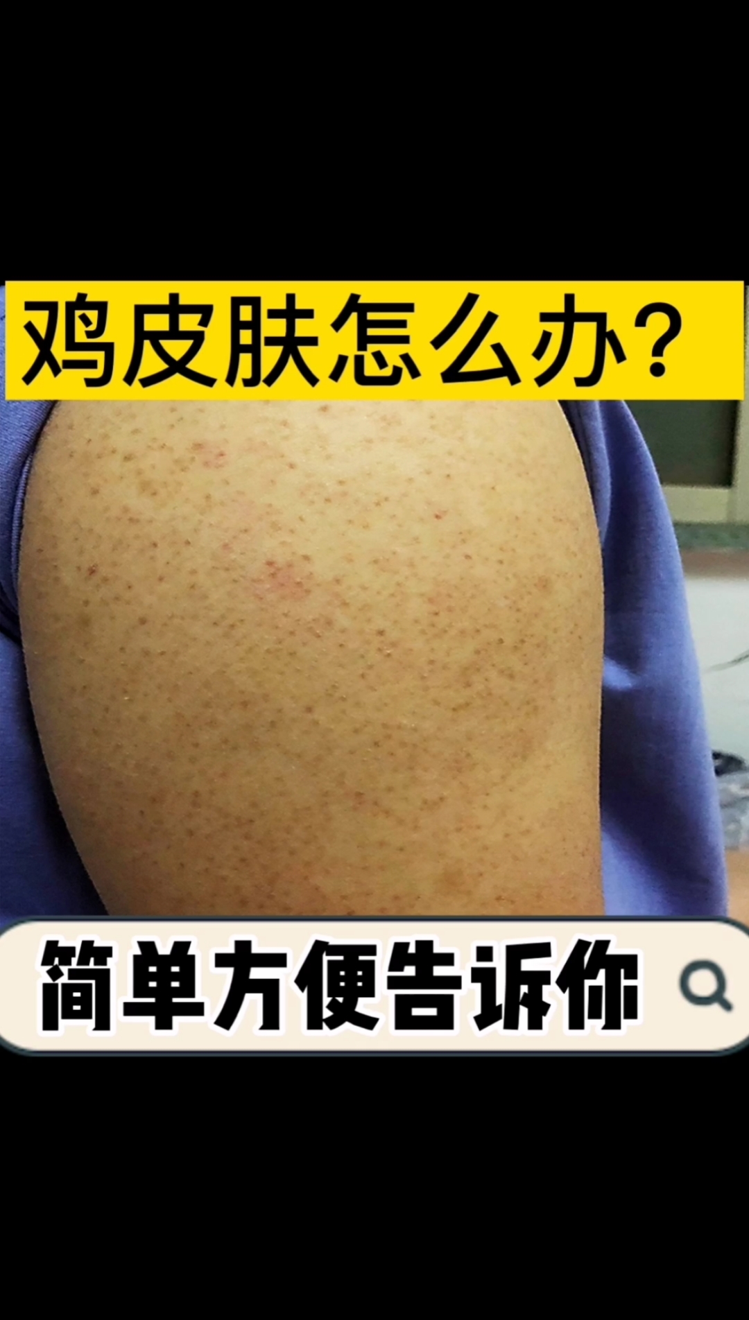 #春天来了#夏天来了,手臂上的鸡皮肤就这么简单