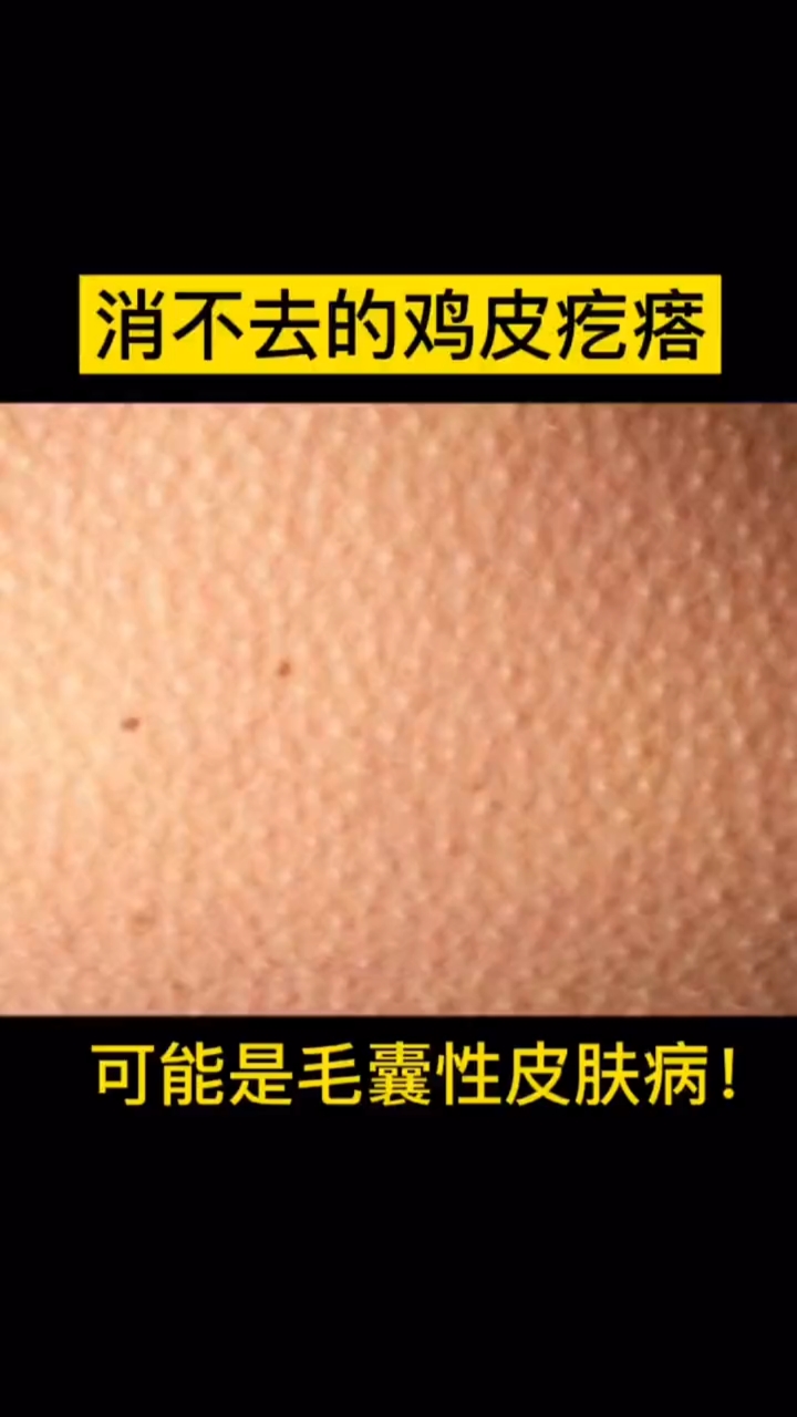 手臂上、腿上如果总是有很多鸡皮疙瘩,并且长时间不消退,要注意了!这个叫毛周角化症