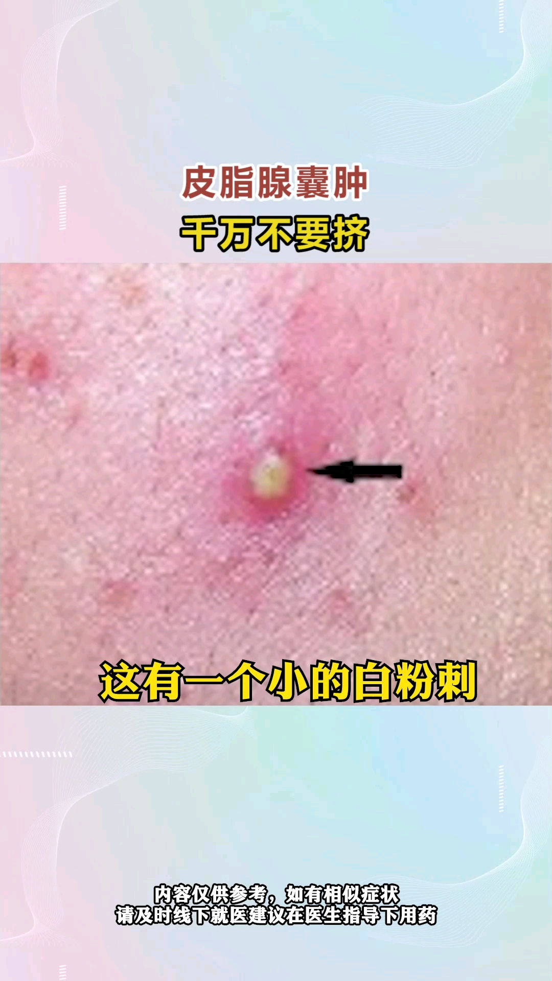 皮脂腺囊肿,千万不要挤!