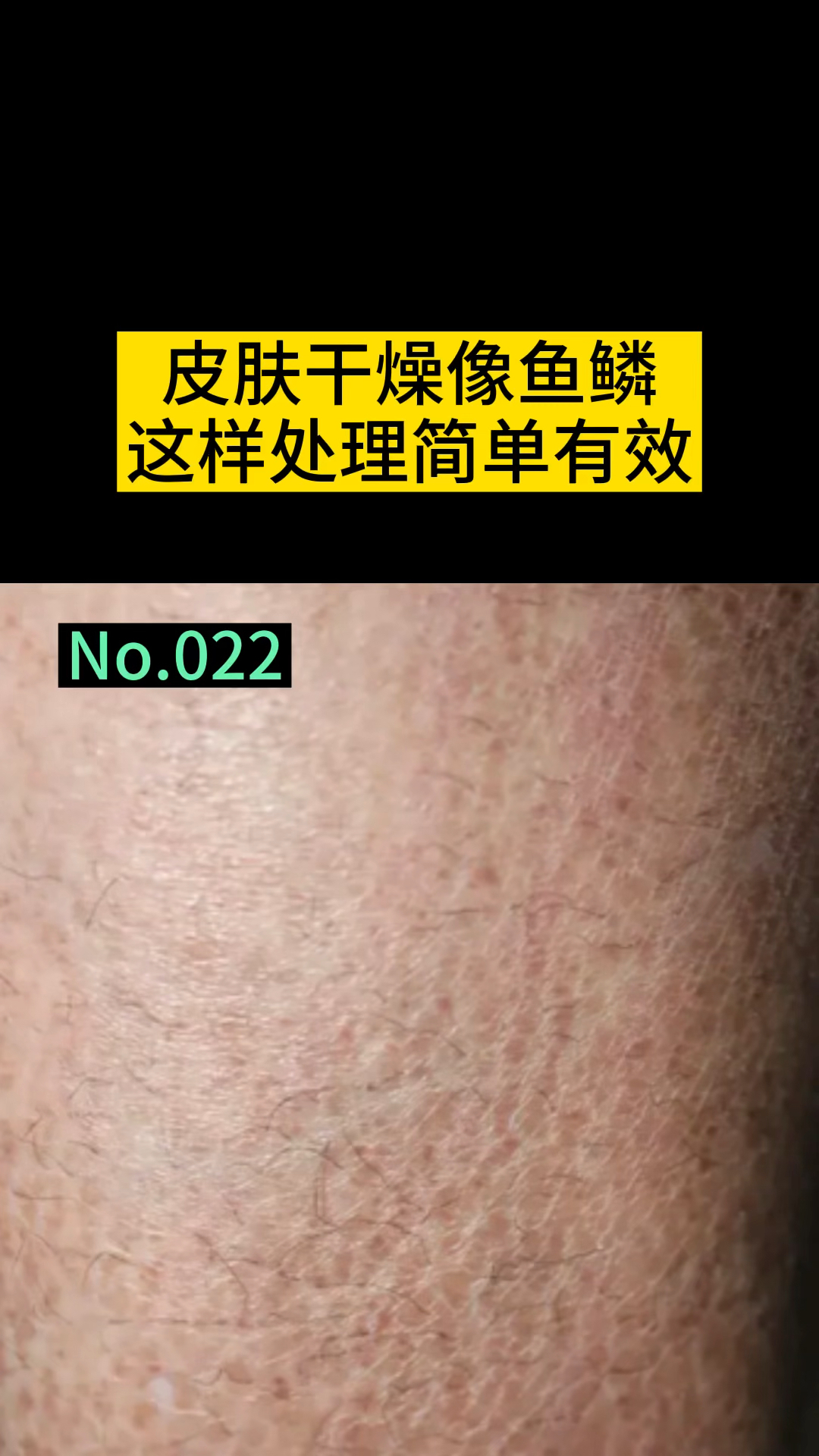 #健康科普#皮肤干燥像鱼鳞一样,快用这个方法啊