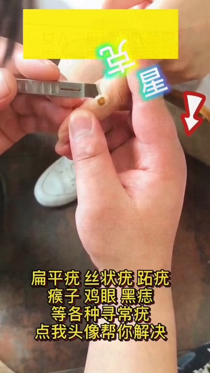 扁平疣丝状疣跖疣瘊子鸡眼黑痣等各种寻常疣点我头像帮你解决