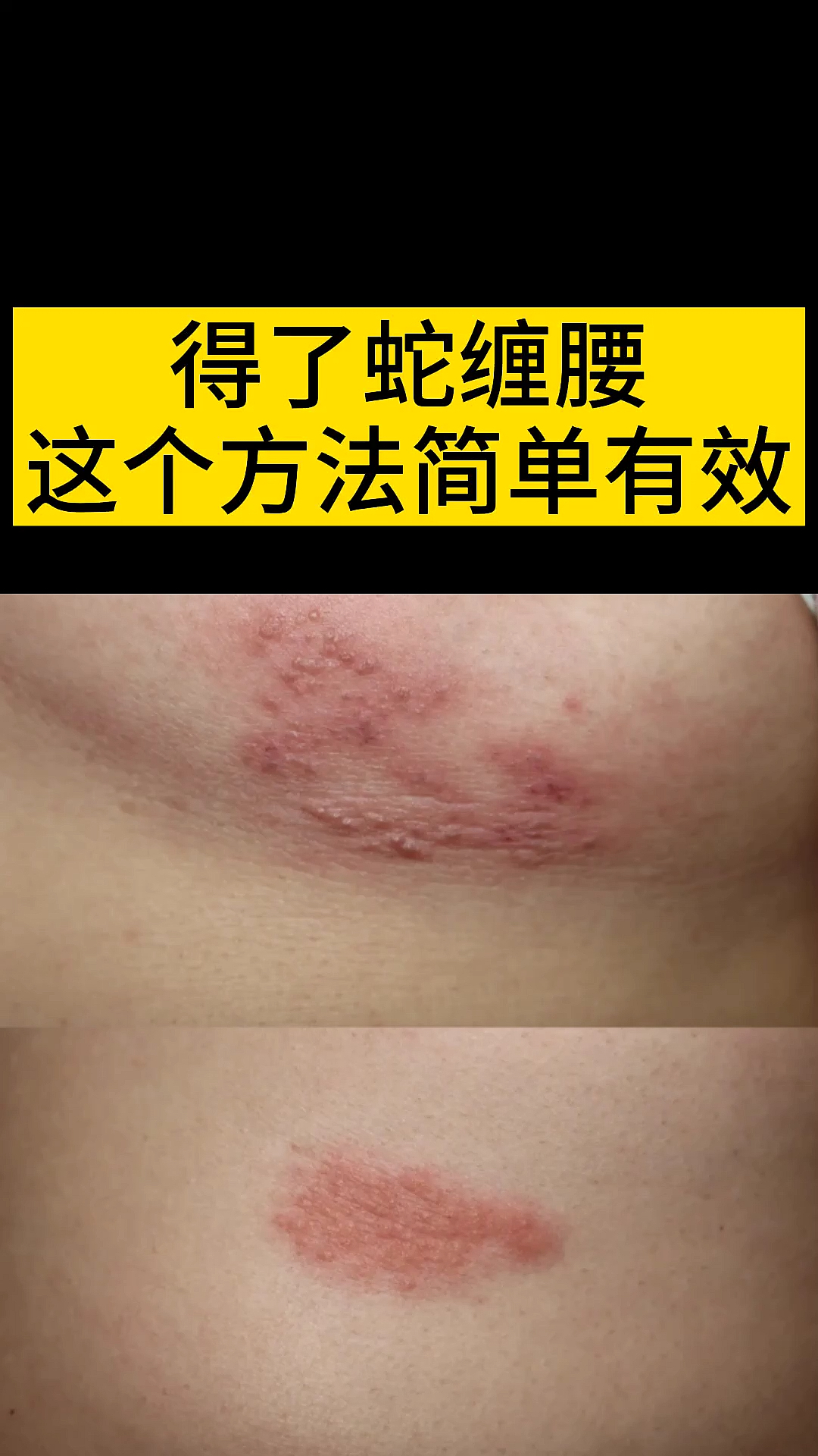 #百里挑一#今天教大家记住这四招,赶走带状疱疹也叫蛇缠腰!