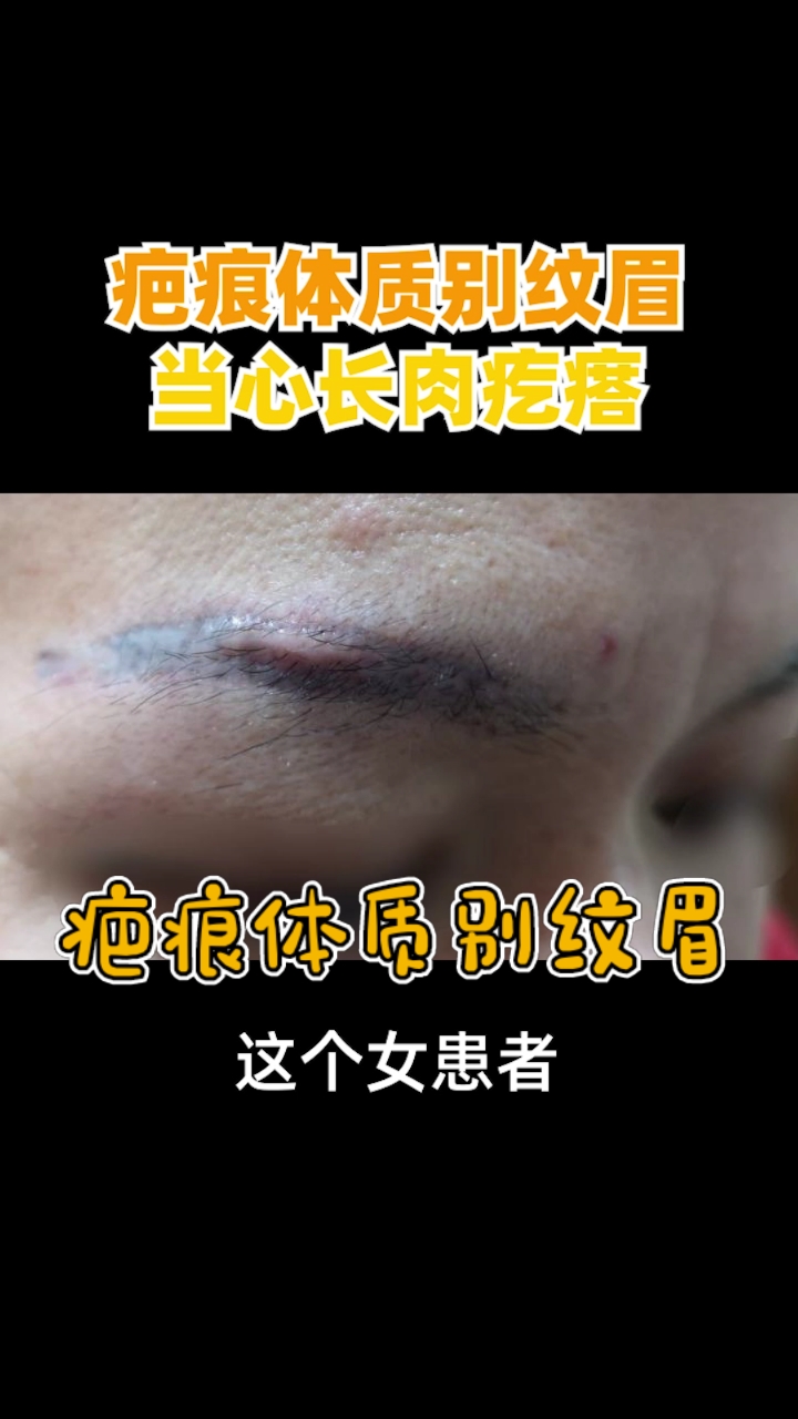 疤痕体质别纹眉,当心长疤痕疙瘩!