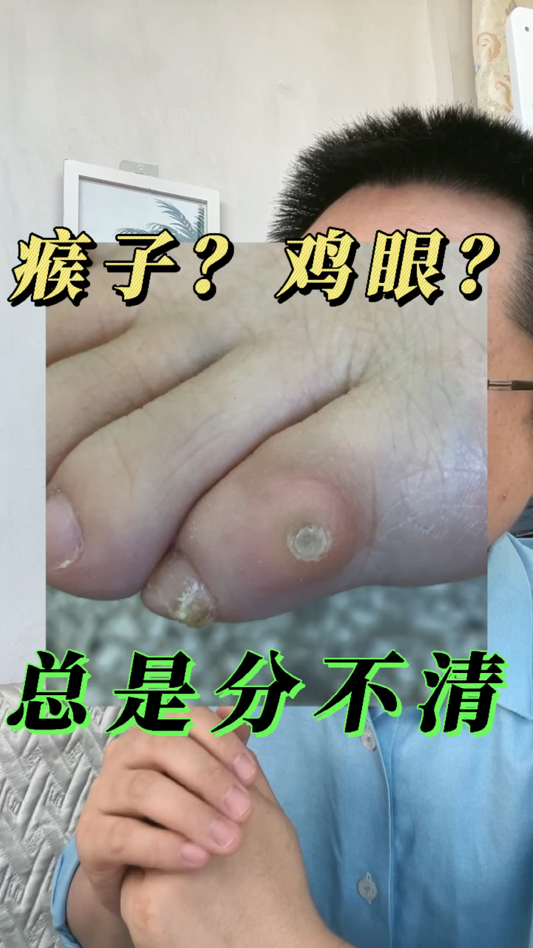 #全民医生说#瘊子,鸡眼,傻傻总是分不清