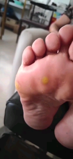 足底鸡眼老茧