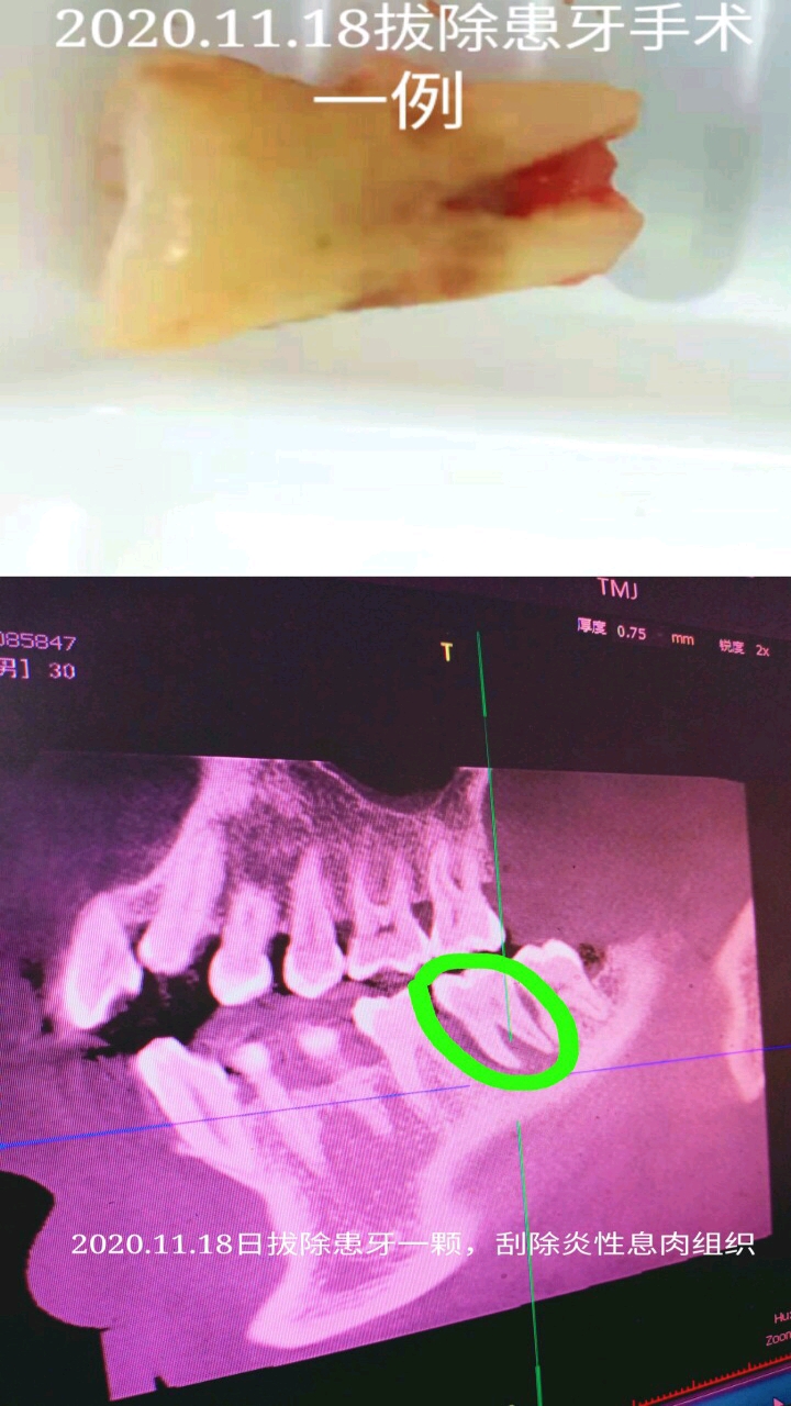 2020.11.18日唐县南环振华口腔,拔除患牙,刮除炎性息肉组织手术一例!