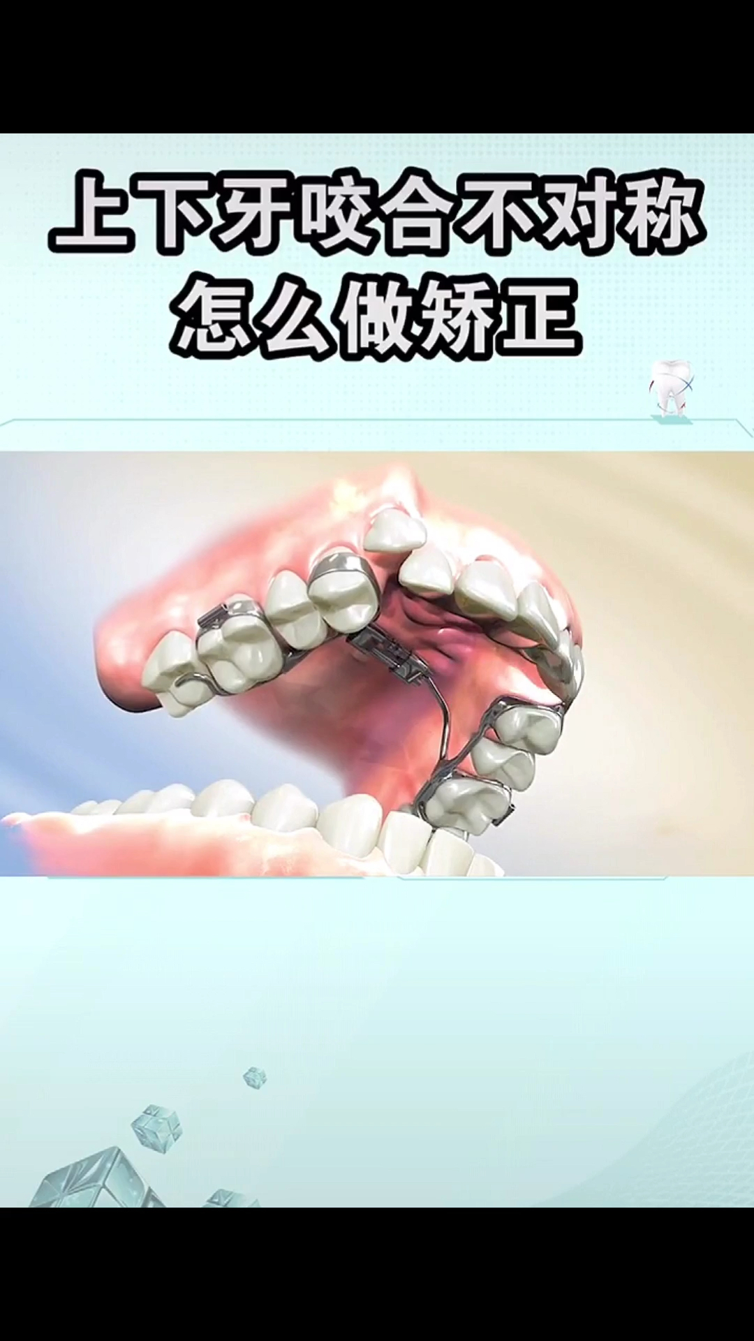 #口腔健康#长期不对称的咬合会导致面部肌肉发育不对称,造成外嘴、大小脸噢。