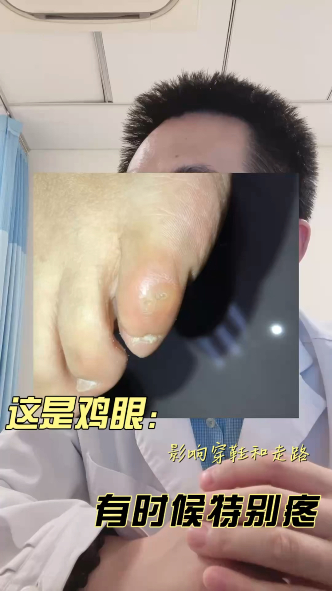 #全民医生说#脚上的鸡眼，有的时候会很疼的