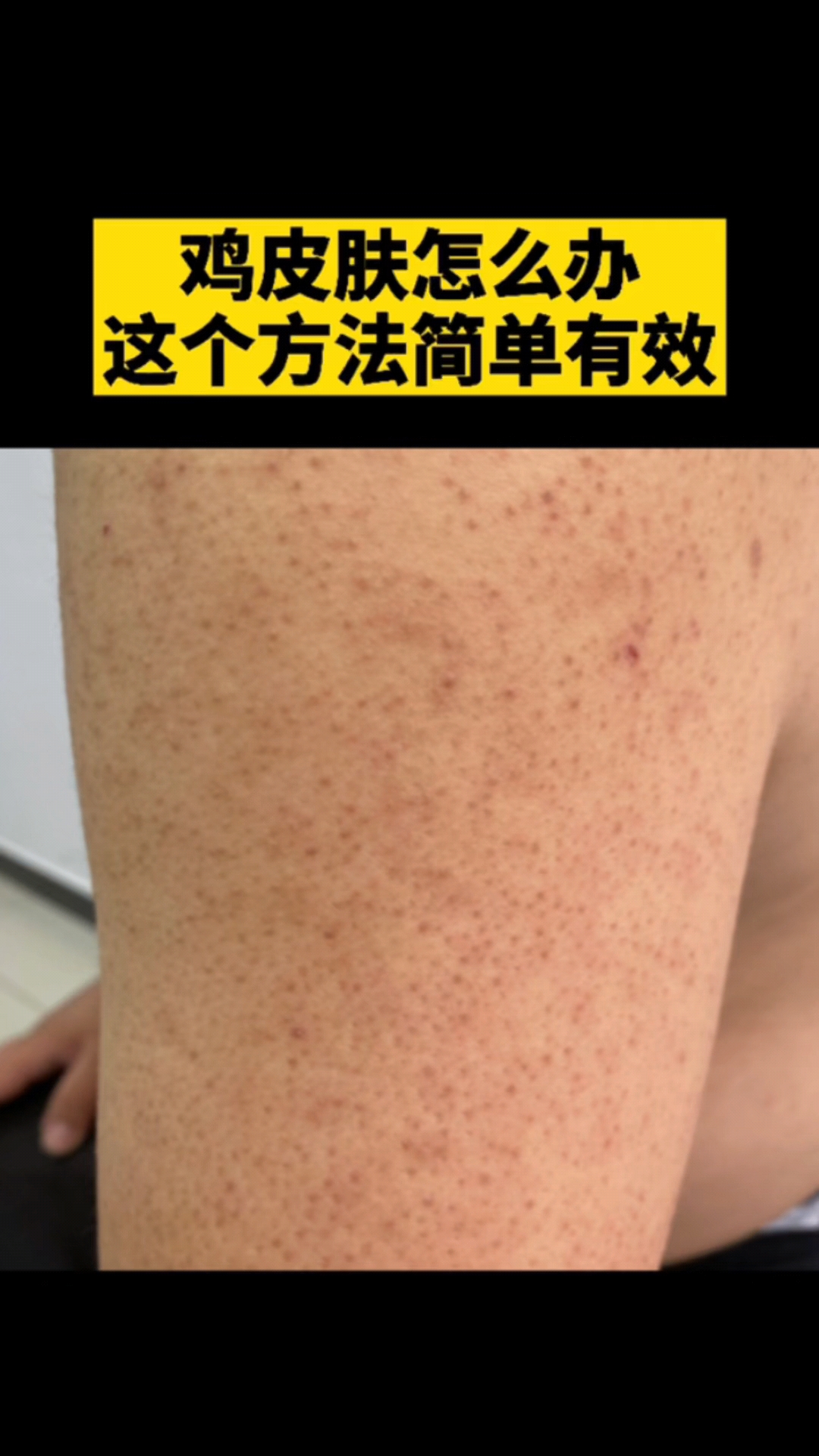 #美容护肤#鸡皮肤怎么办？记住这个方法很有效！