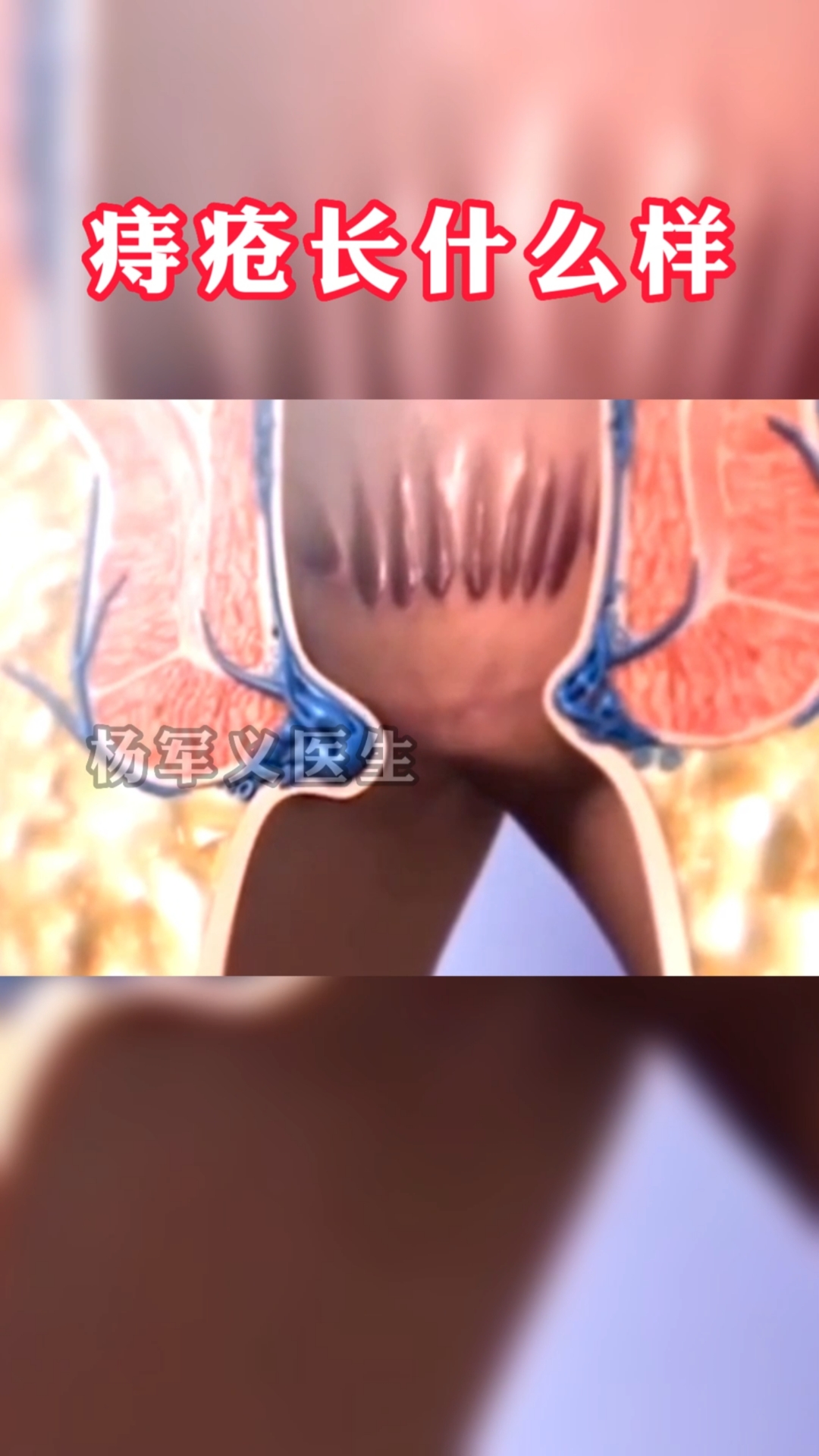 痔疮长什么样