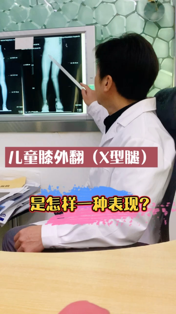 育儿儿童膝外翻x型腿是怎样一种表现快来对照看看是不是这种情况吧