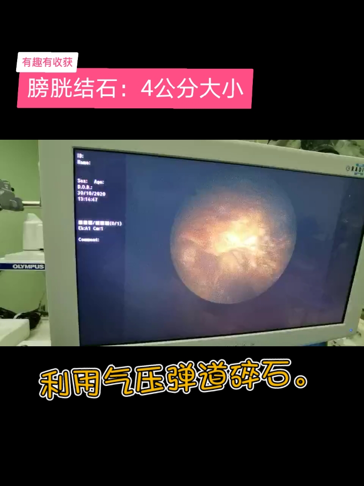 膀胱结石#膀胱结石:气压弹道碎石