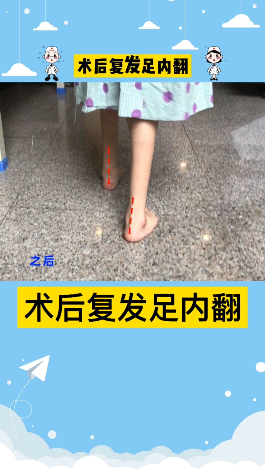马蹄内翻足#足内翻治疗后小女孩又可以正常行走了.为什么要说又?