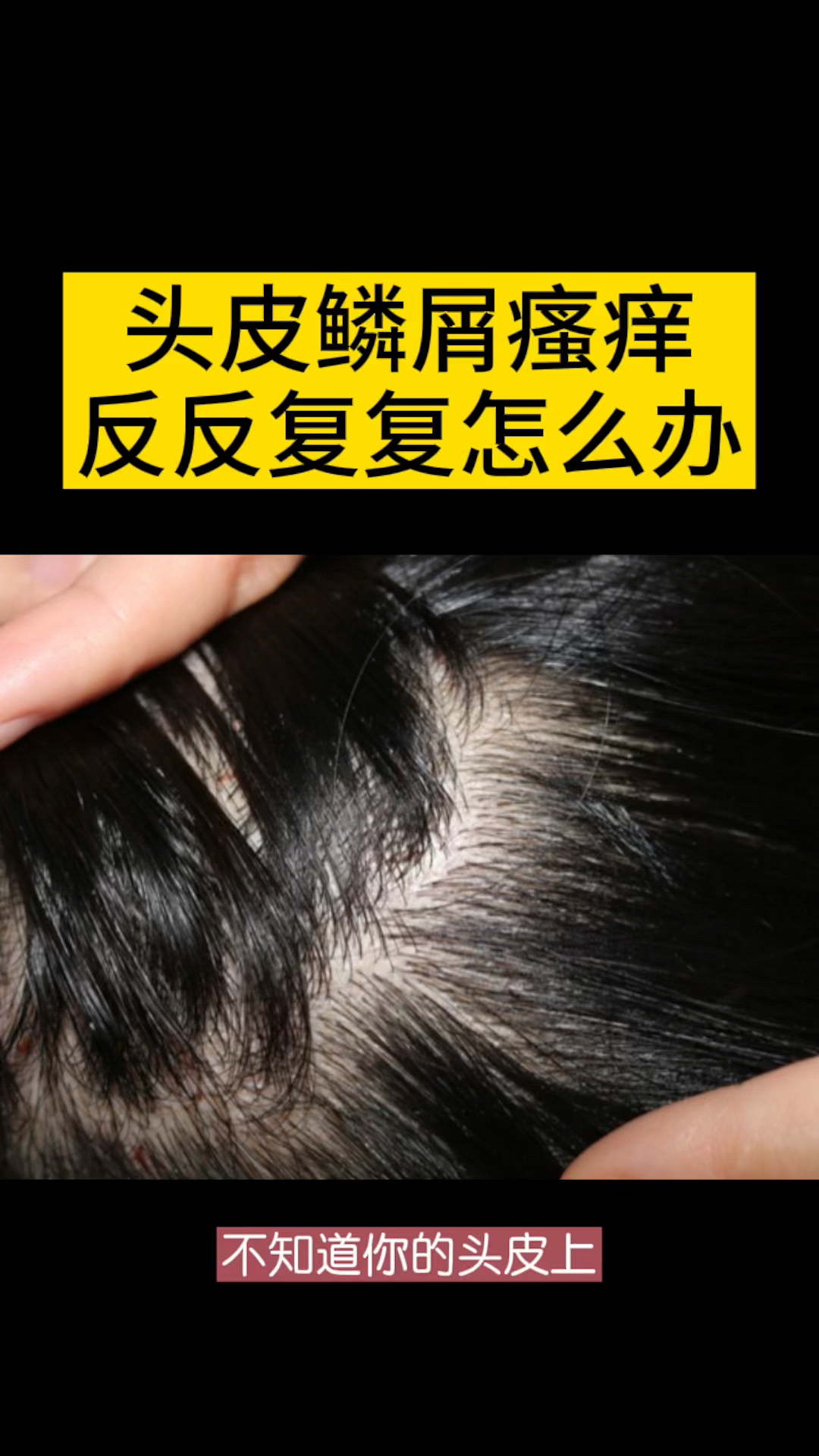 头皮屑头皮鳞屑瘙痒反反复复怎么办