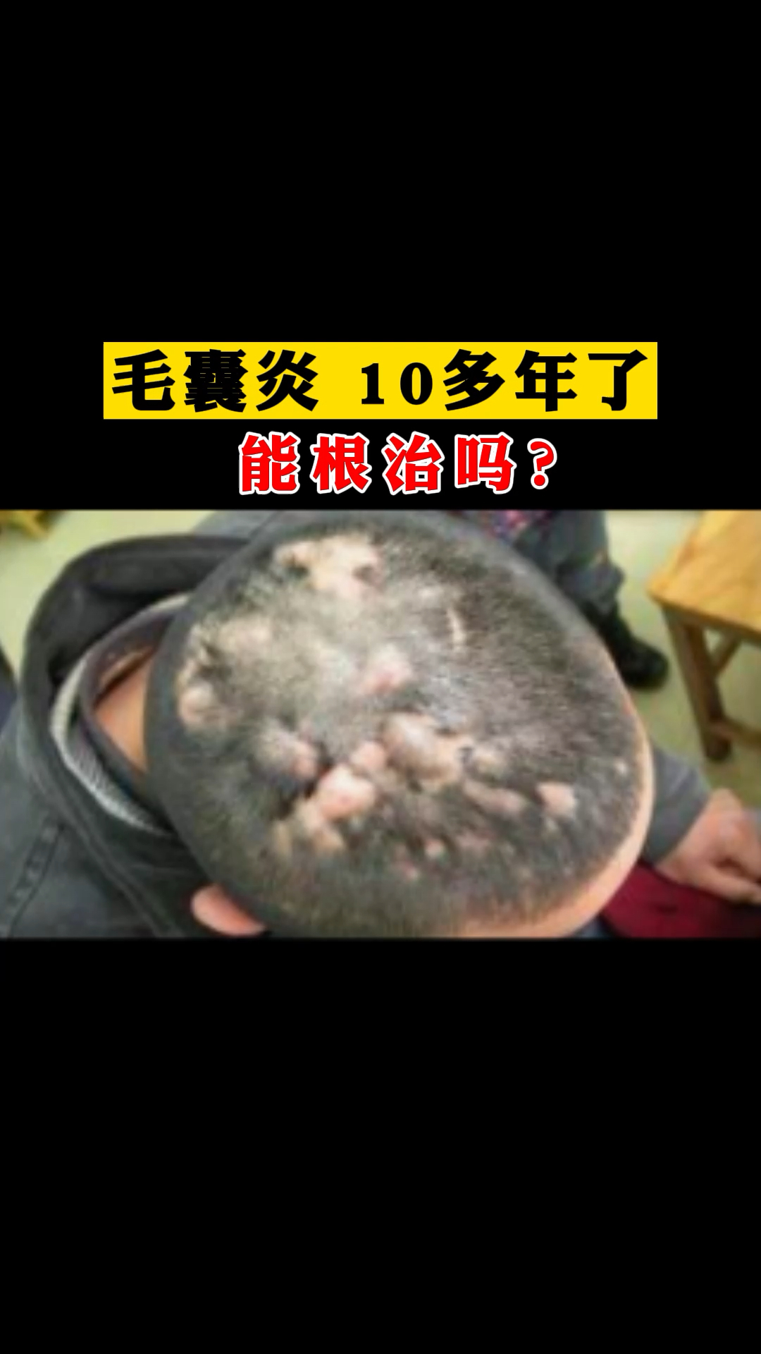 毛囊炎脓包头皮屑出油毛囊炎10多年了能根治吗