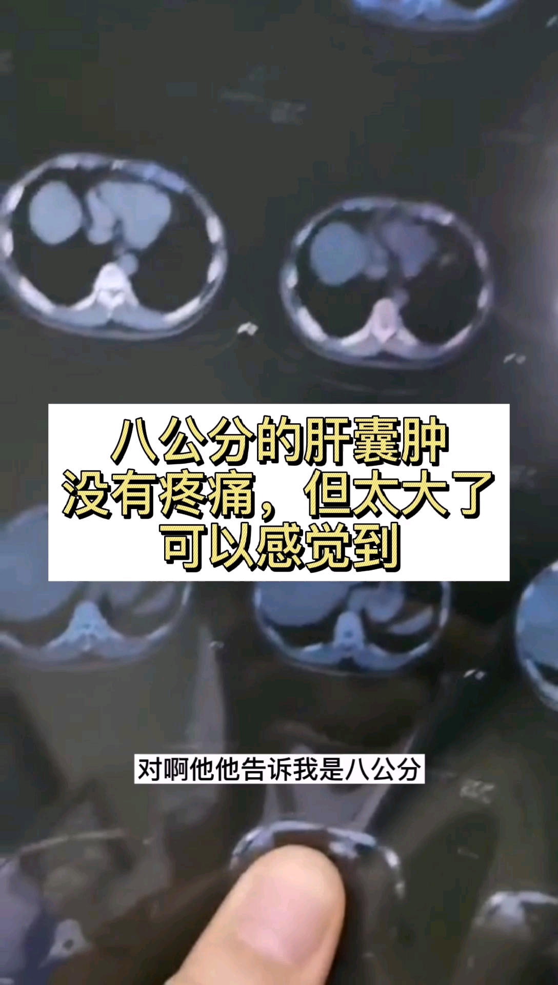 肝囊肿八公分的肝囊肿没有疼痛但由于太大了患者自己可以感觉到