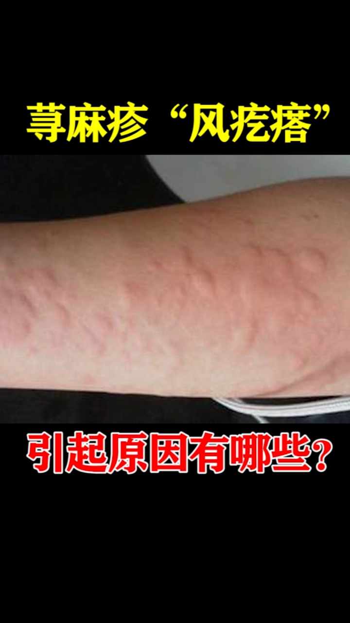 荨麻疹又叫风疙瘩它引起原因有哪些