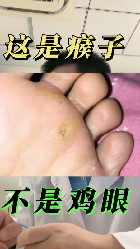 全民医生说千万不要把脚上的瘊子当成鸡眼因为它有传染性可能会越长越