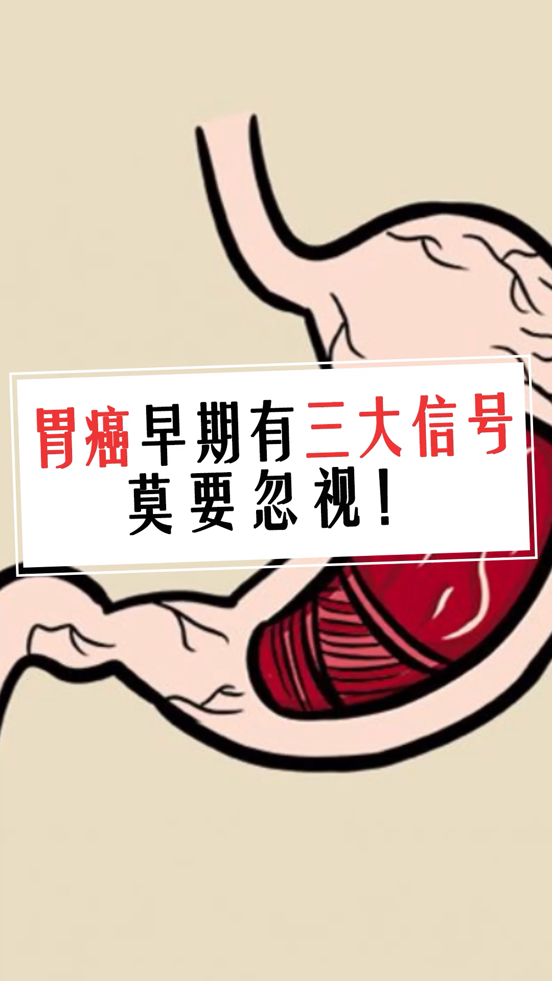 胃癌早期有三大信号莫要忽视