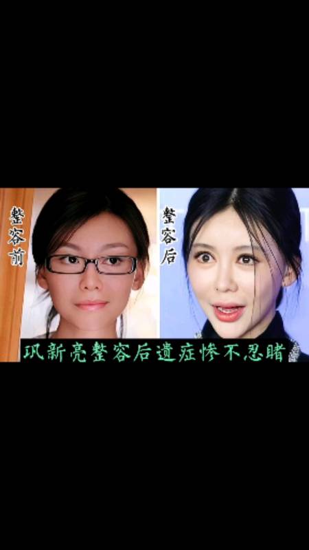 巩新亮整容前后对比,网友:整残了,你觉得呢?