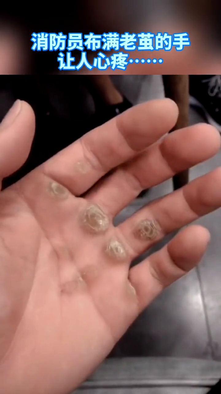 消防员的手原来长这样……你愿意为这双布满老茧,饱经风霜的手点赞吗?