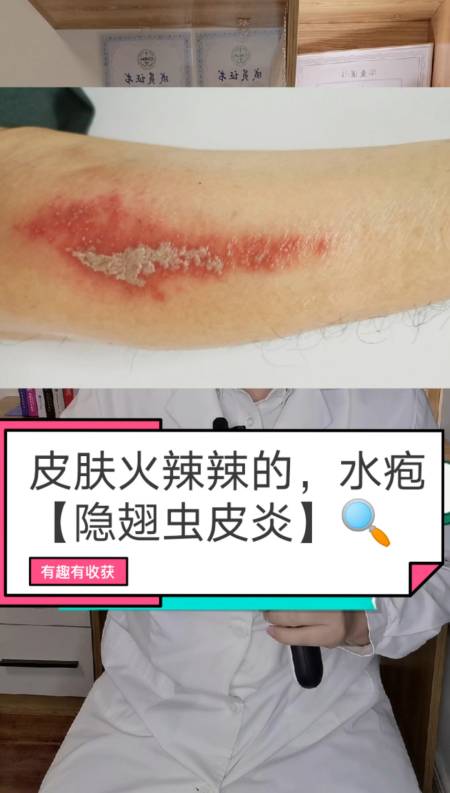 每天一点冷知识#夏天隐翅虫皮炎,大家要留意!