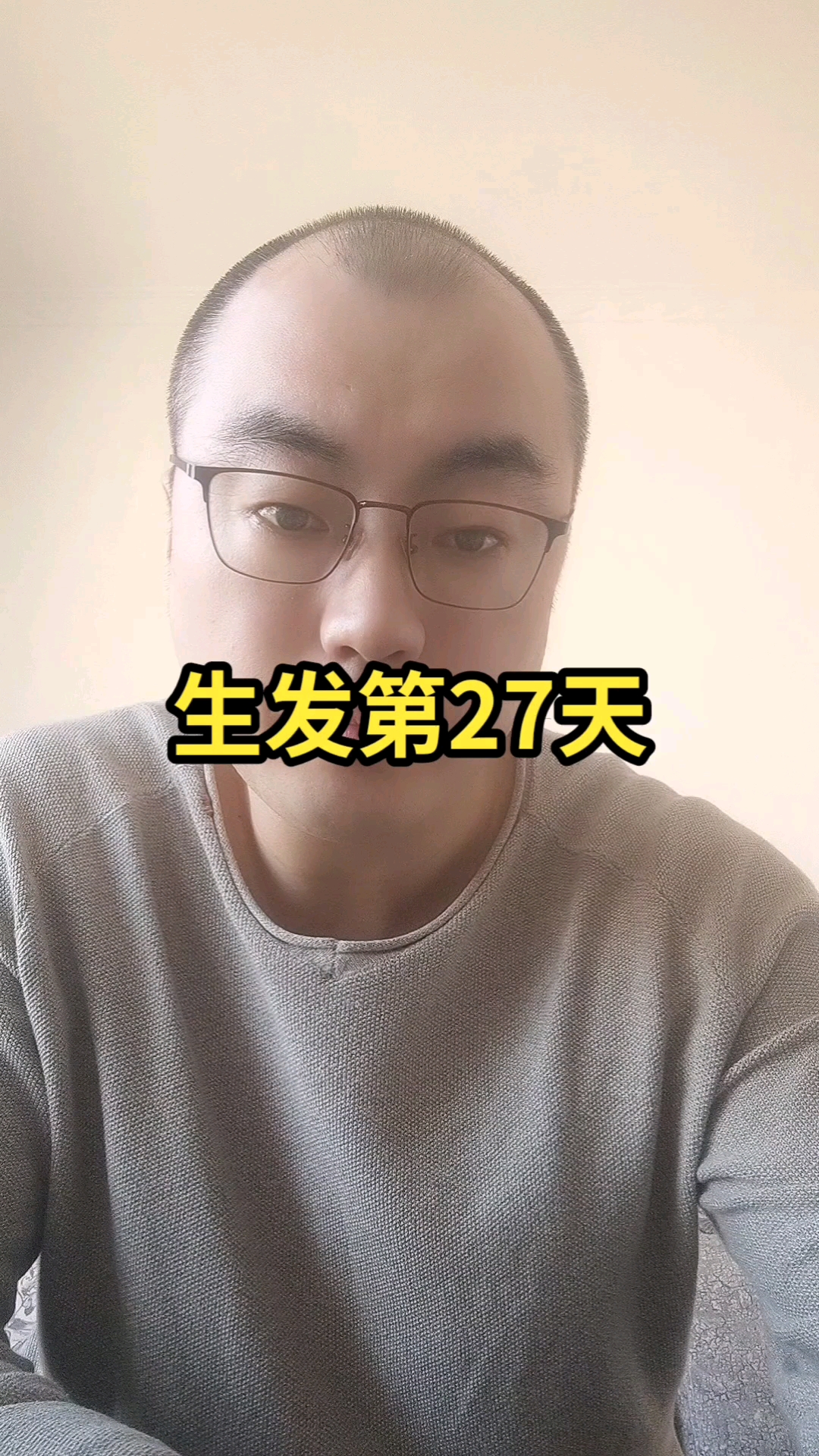 m型天生大秃鬓角同时也是脂溢性脱发治疗第27天头上长了一层小绒毛