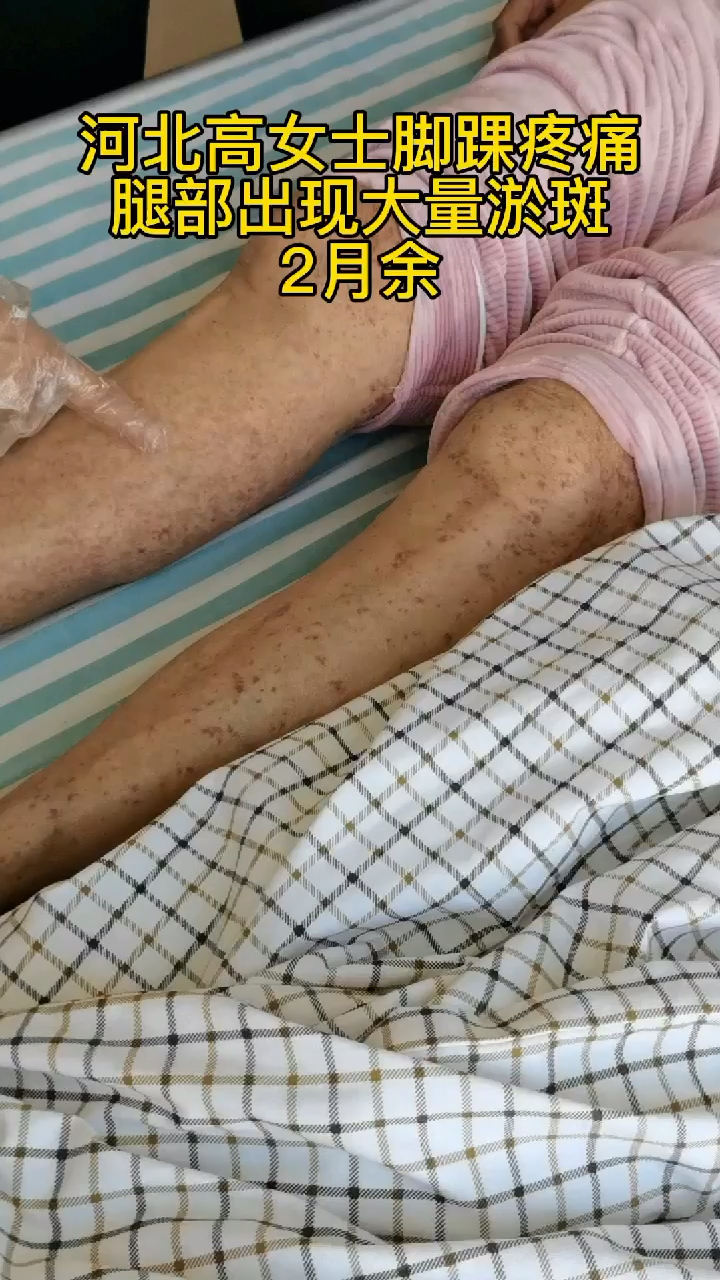 过敏性紫癜高女士因皮肤瘀斑,脚踝疼痛确诊,给她详细检查一下,尽快