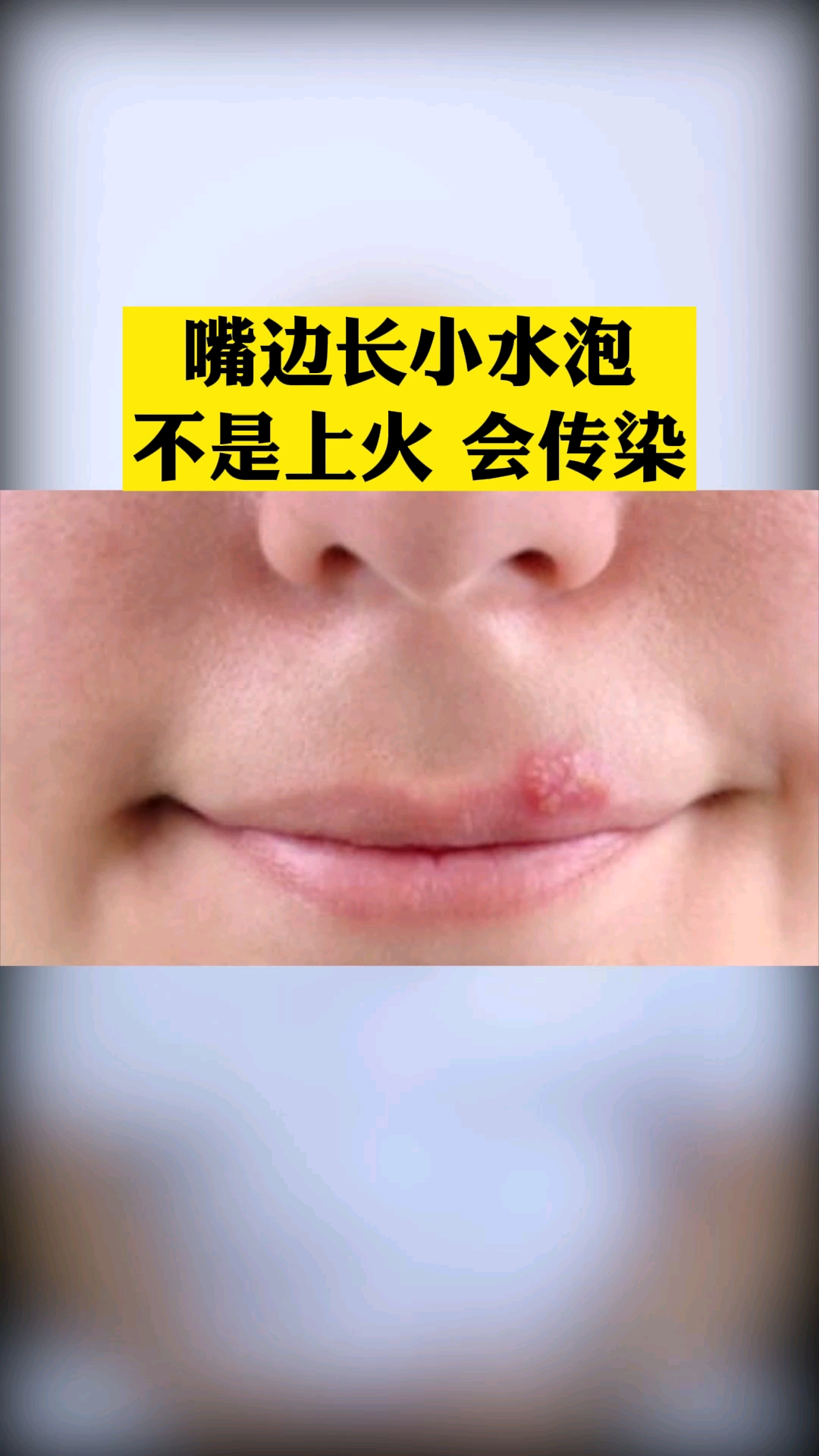 健康养生嘴边长这种小水泡不是上火会传染单纯疱疹