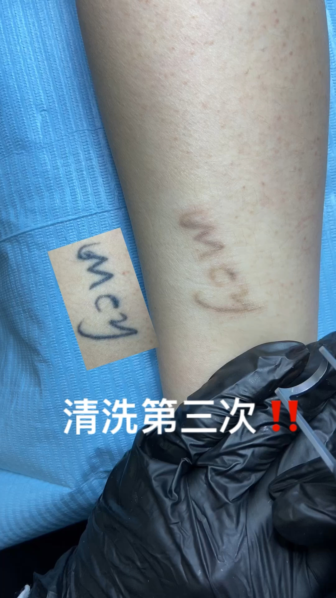 廊坊洗纹身#无痛皮秒洗纹身,清洗第三次.