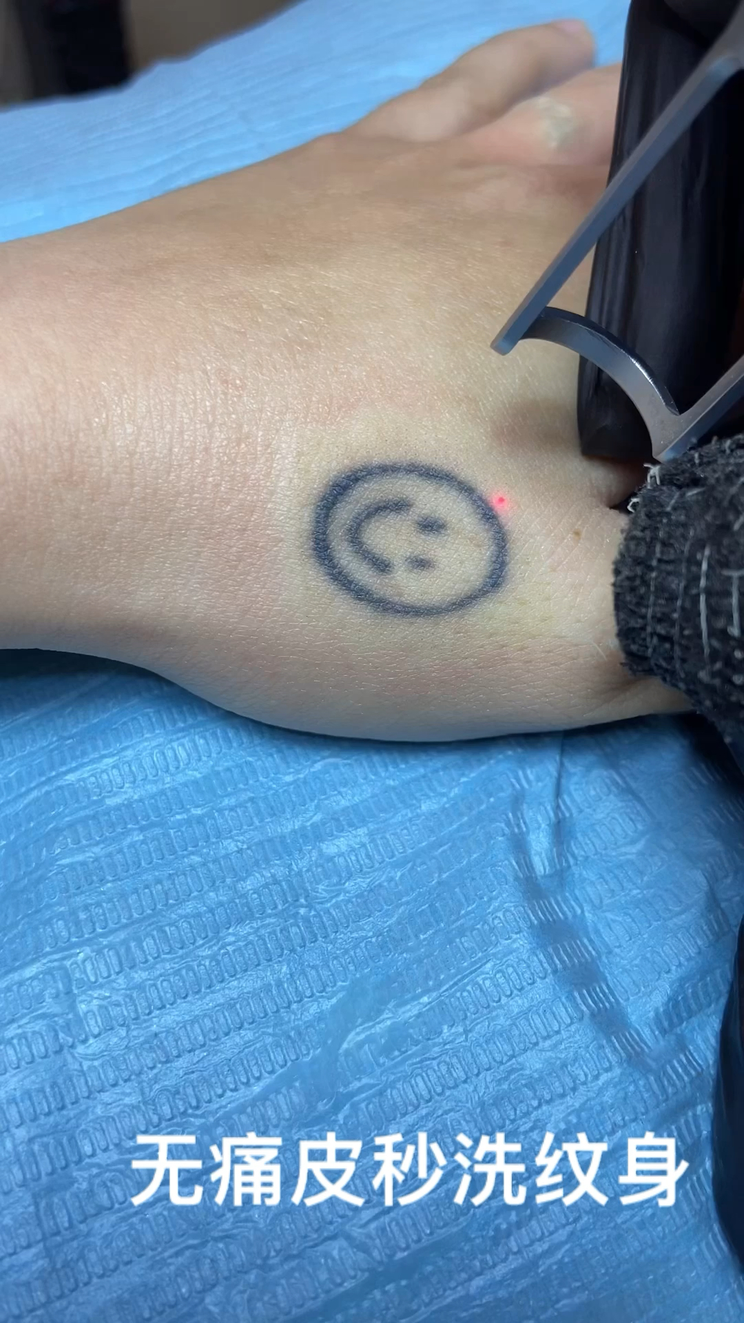 洗纹身无痛皮秒洗纹身清洗第一次不起水泡不留疤一周左右快速修复60