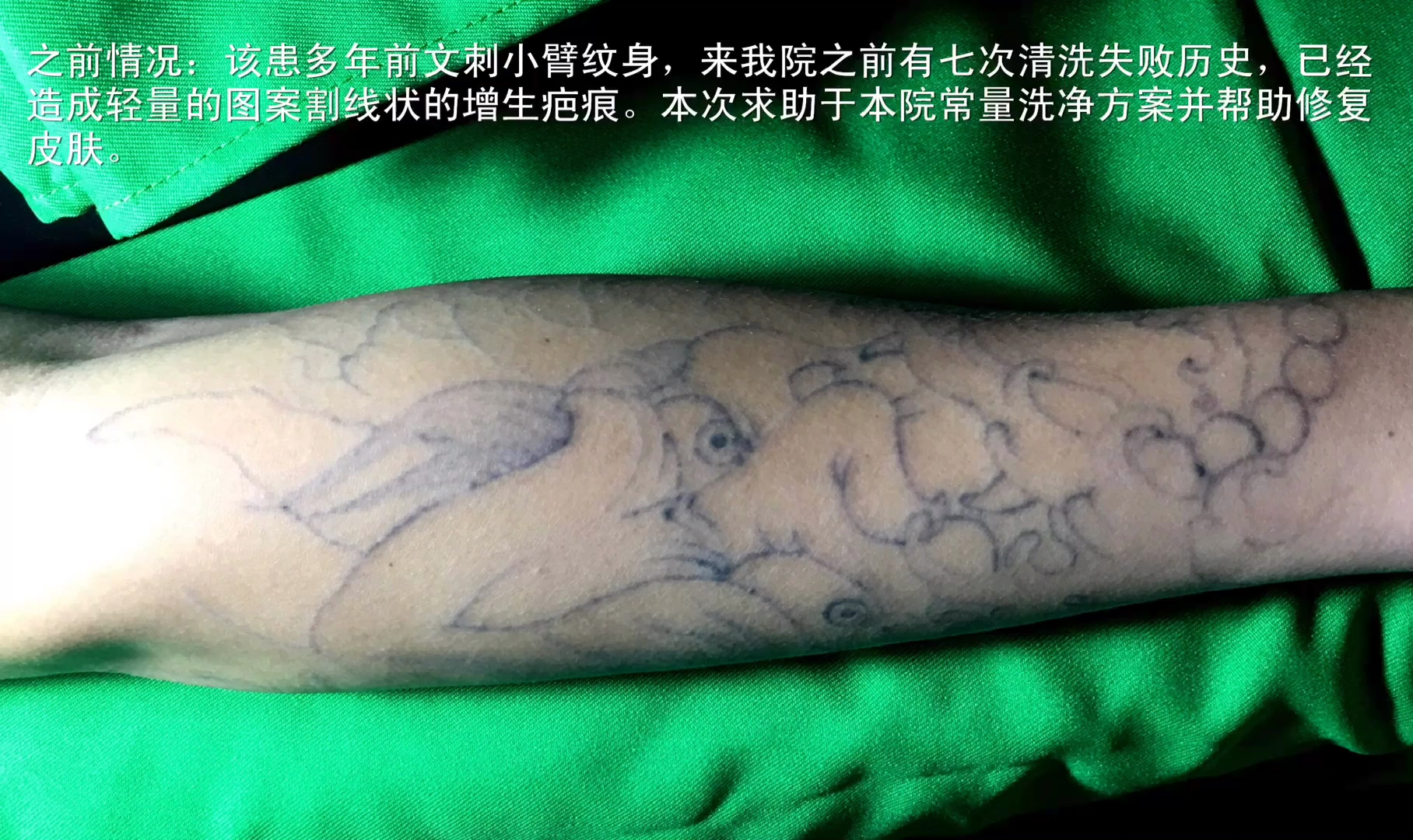 洗纹身#洗纹身视频,洗彩色纹身.大连尚都绅殿洗纹身效果